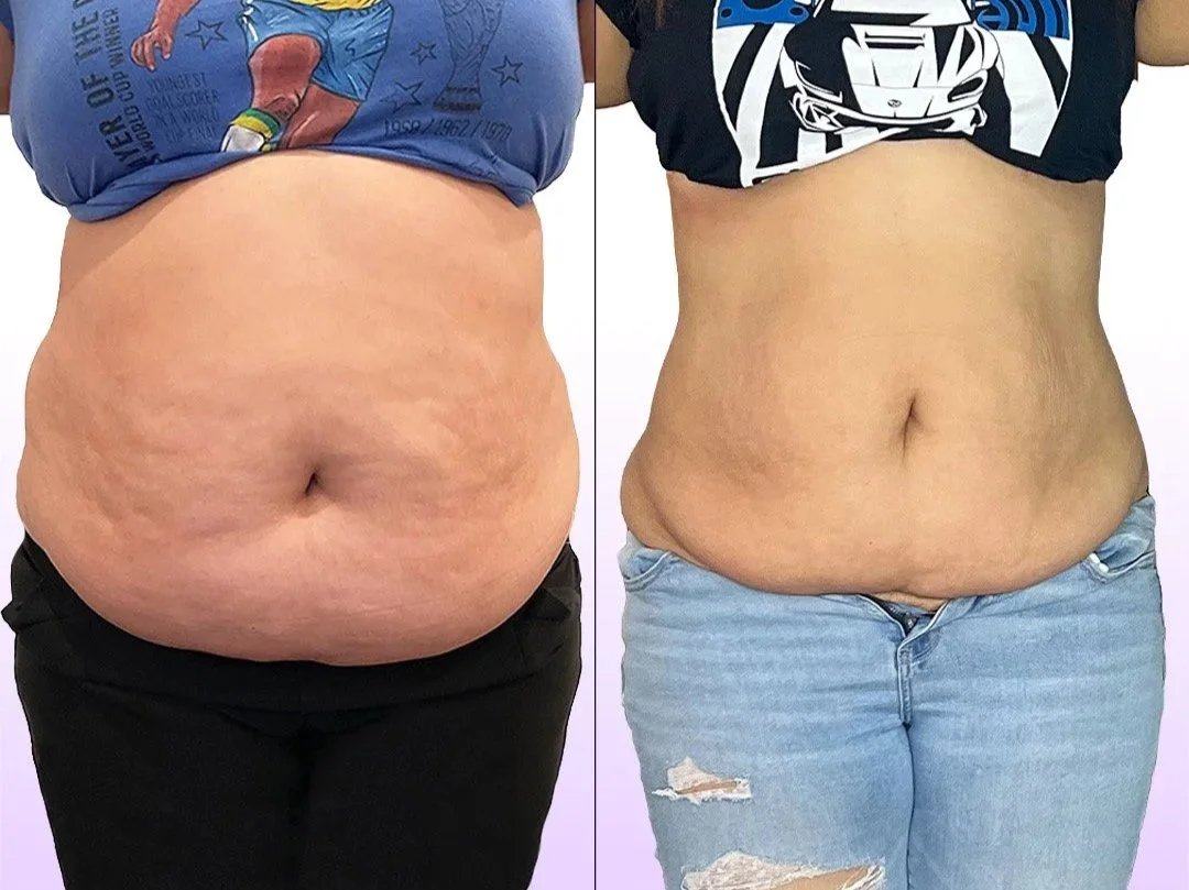 Noninvasive Tummy Tuck treatment before and after showing tightened abdomen without surgery in Los Angeles