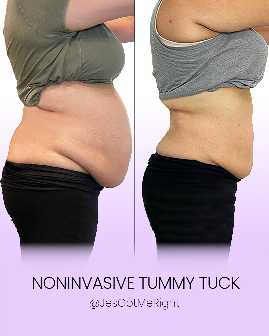 Side-view before and after comparison of a woman’s abdomen showing reduced lower belly fullness and improved skin firmness after a noninvasive tummy tuck treatment