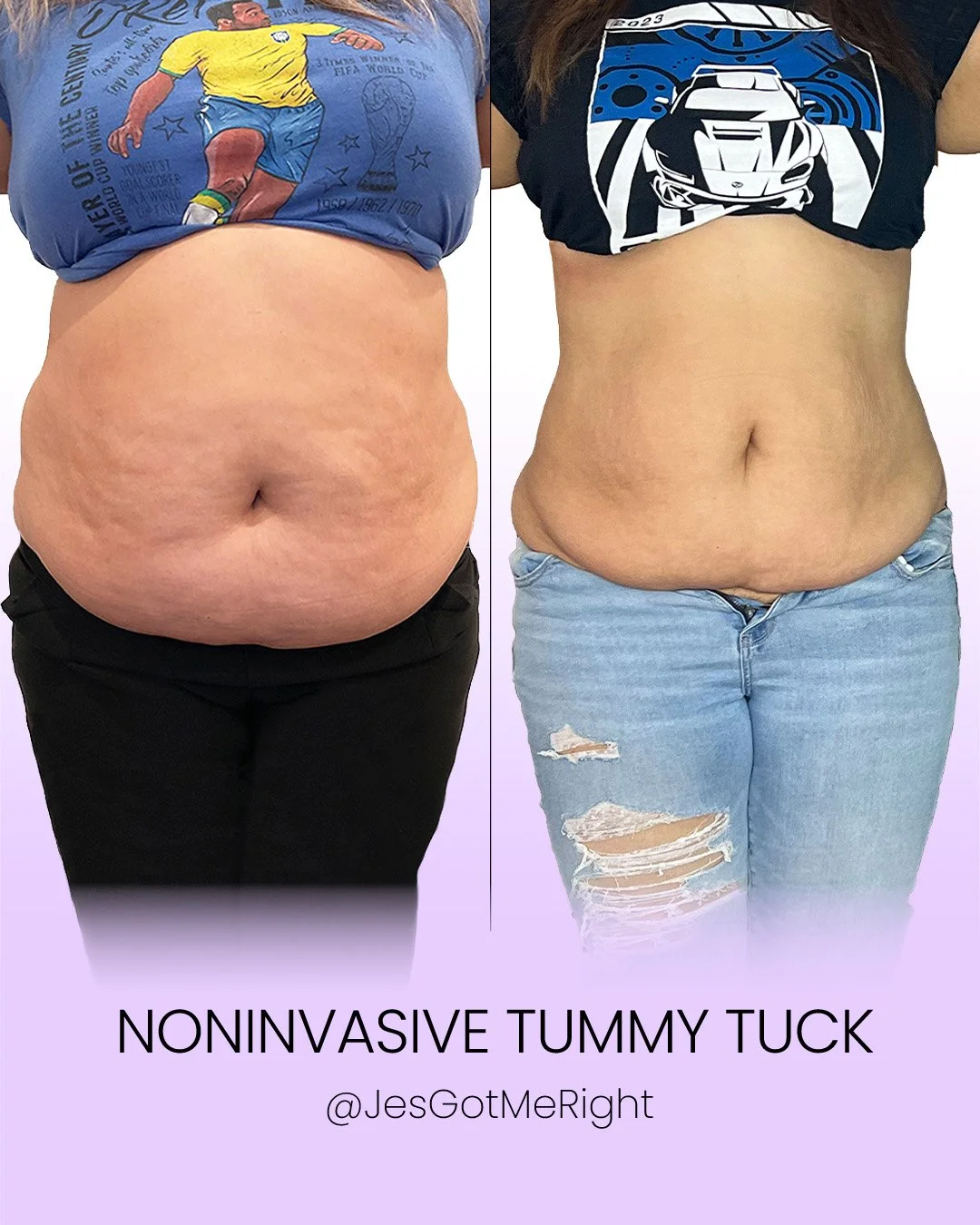 Noninvasive tummy tuck before and after results showing reduced stubborn belly fat and smoother abdominal skin in the San Fernando Valley