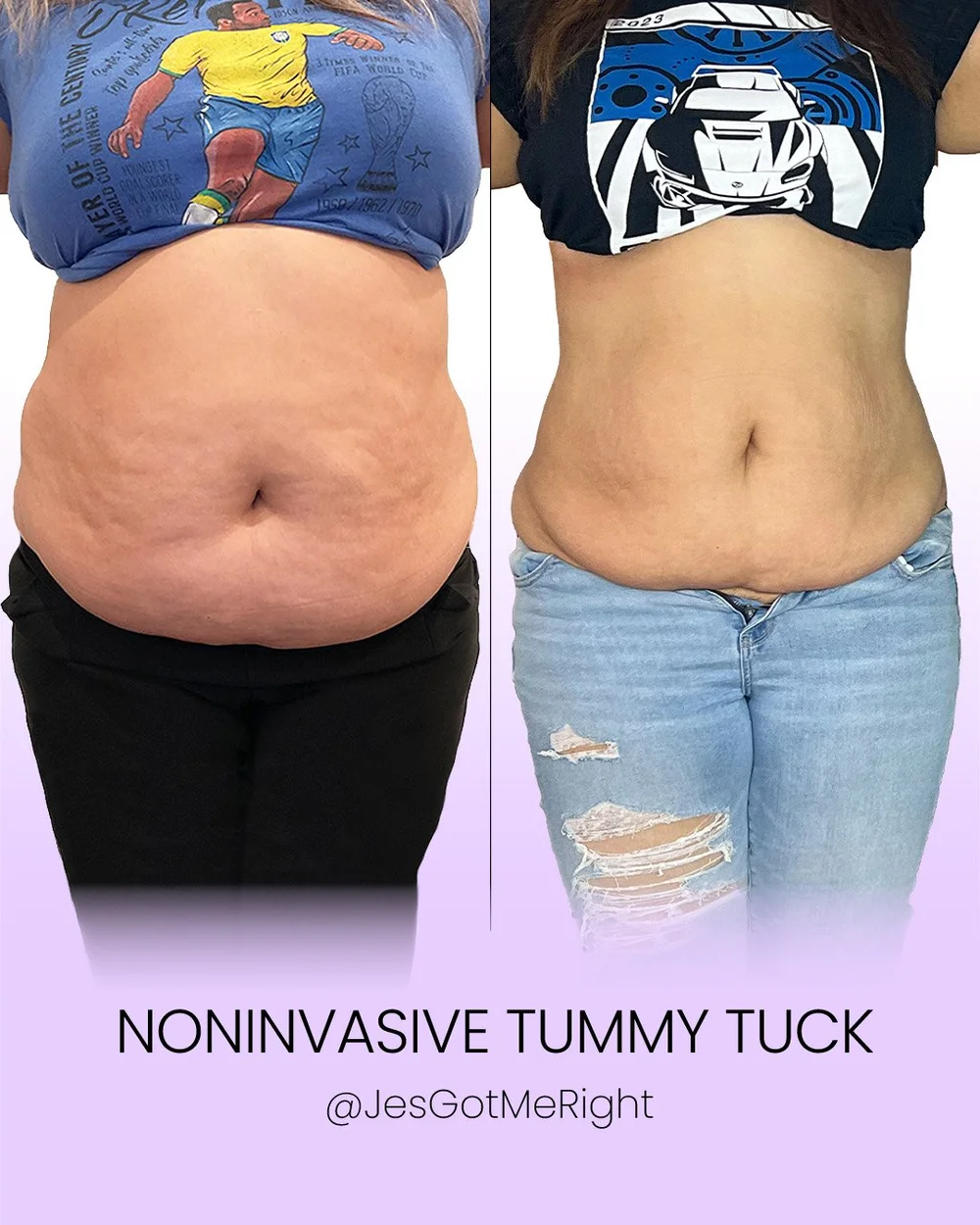 Noninvasive tummy tuck client result