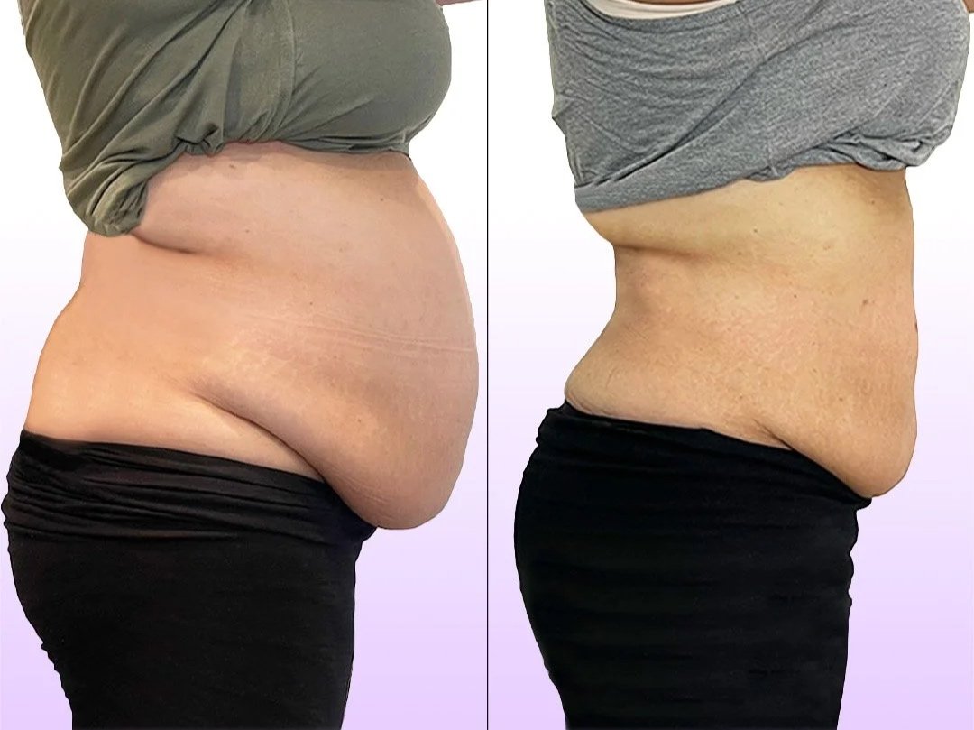Noninvasive Tummy Tuck before and after showing post weight loss loose skin tightening without surgery for lower belly