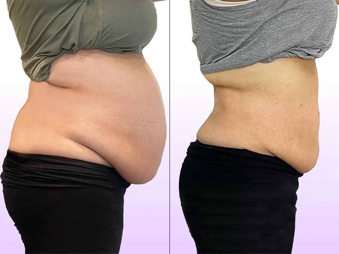 Noninvasive tummy tuck client before-and-after result