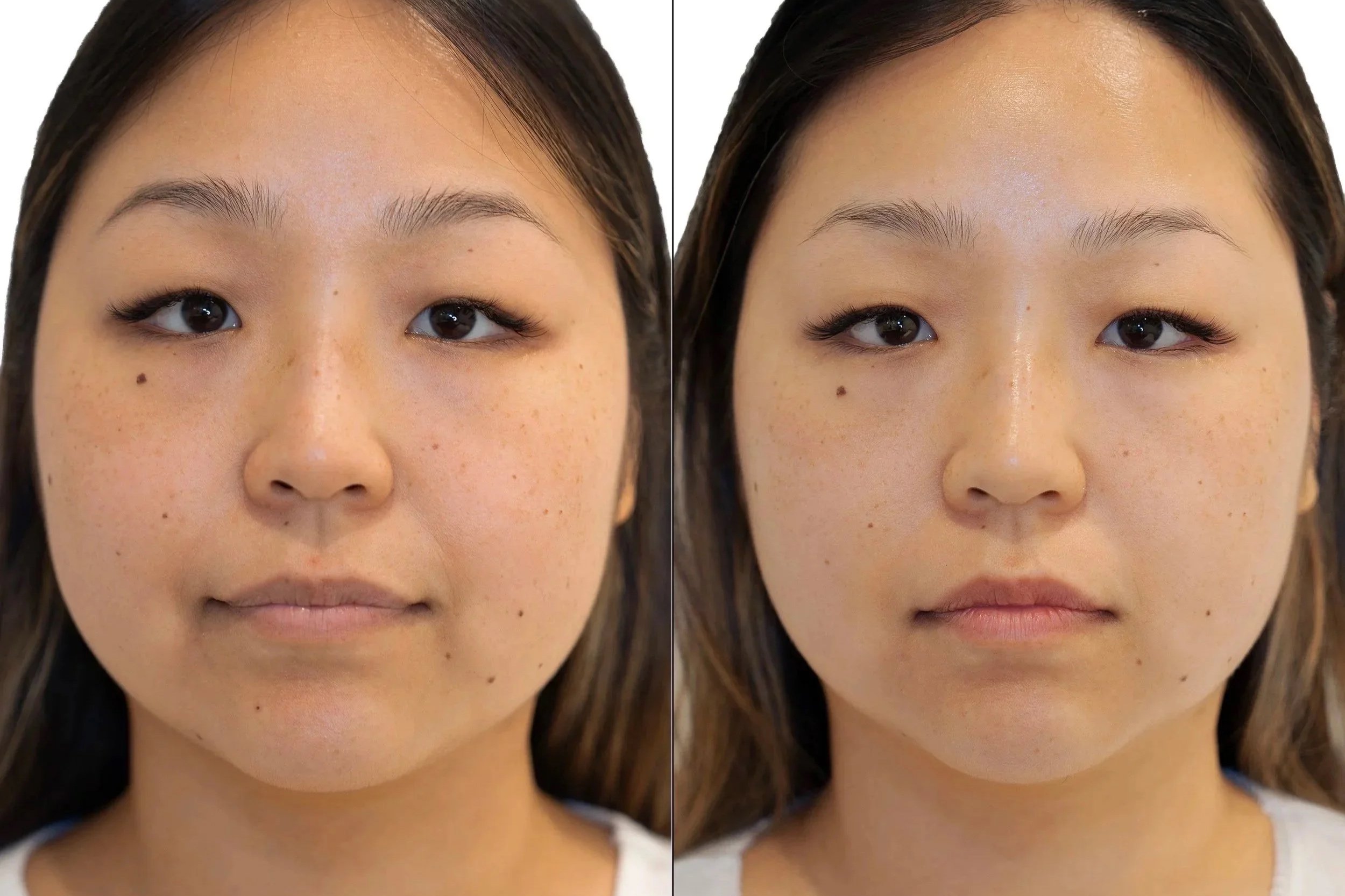 Jet Plasma Facelift before and after results showing reduced puffiness in the face with visible lifting and tightening along the jawline and cheeks