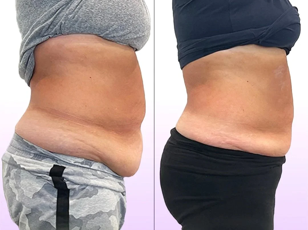 Noninvasive Tummy Tuck before and after showing port partum belly lifting without surgery for lower belly