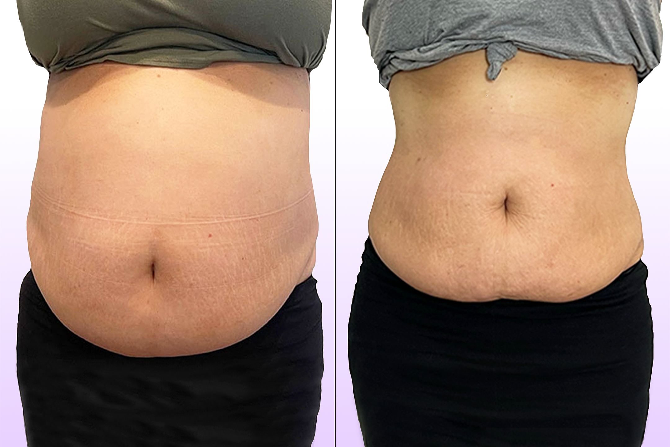 Noninvasive Tummy Tuck treatment before and after showing slimmed waistline and lifted lower belly in the abdominal area