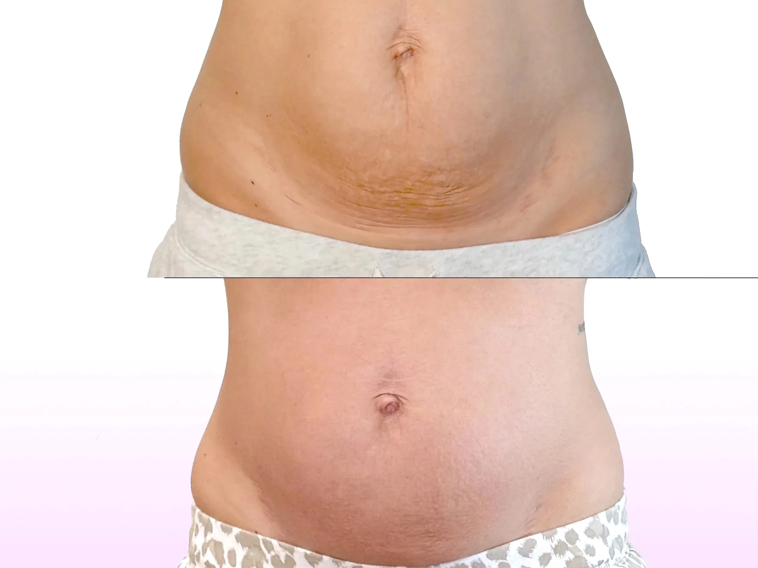 Noninvasive Tummy Tuck treatment before and after showing reduced belly after glp-1 weight loss without surgery for lower belly