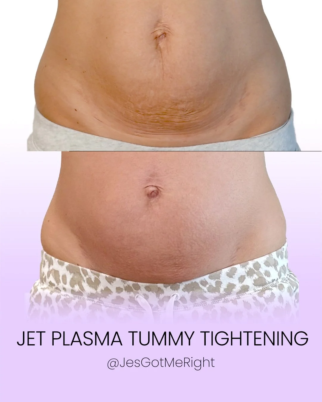 Jet plasma tummy tightening before and after showing improved skin texture and firmer lower abdomen