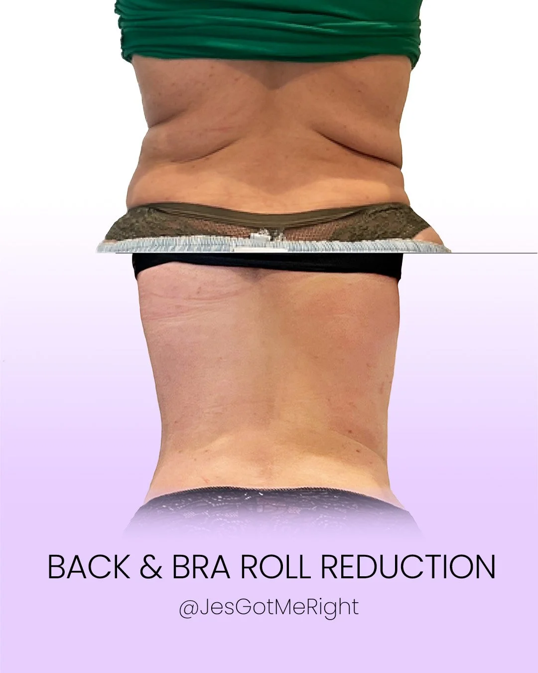 Back and bra roll reduction before and after showing smoother upper back and reduced bra line fullness without surgery