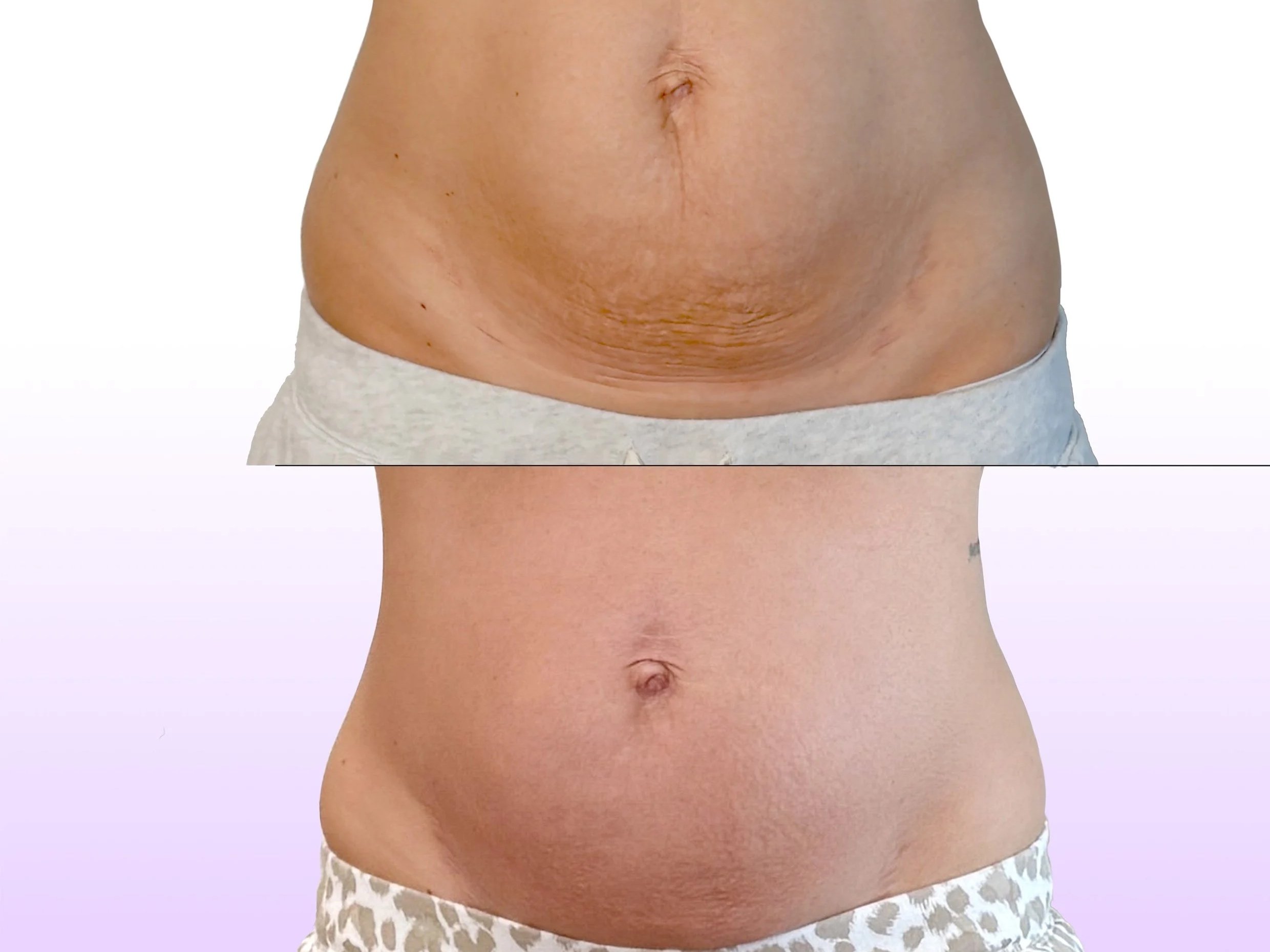 Noninvasive Tummy Tuck before and after showing post weight loss loose skin tightening without surgery for lower belly skin sagging
