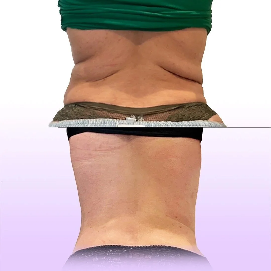 Back and Bra Roll Reduction before and after result showing client transformation from 3 treatments providing a smooth, toned, and lifted back with Jes Got Me Right