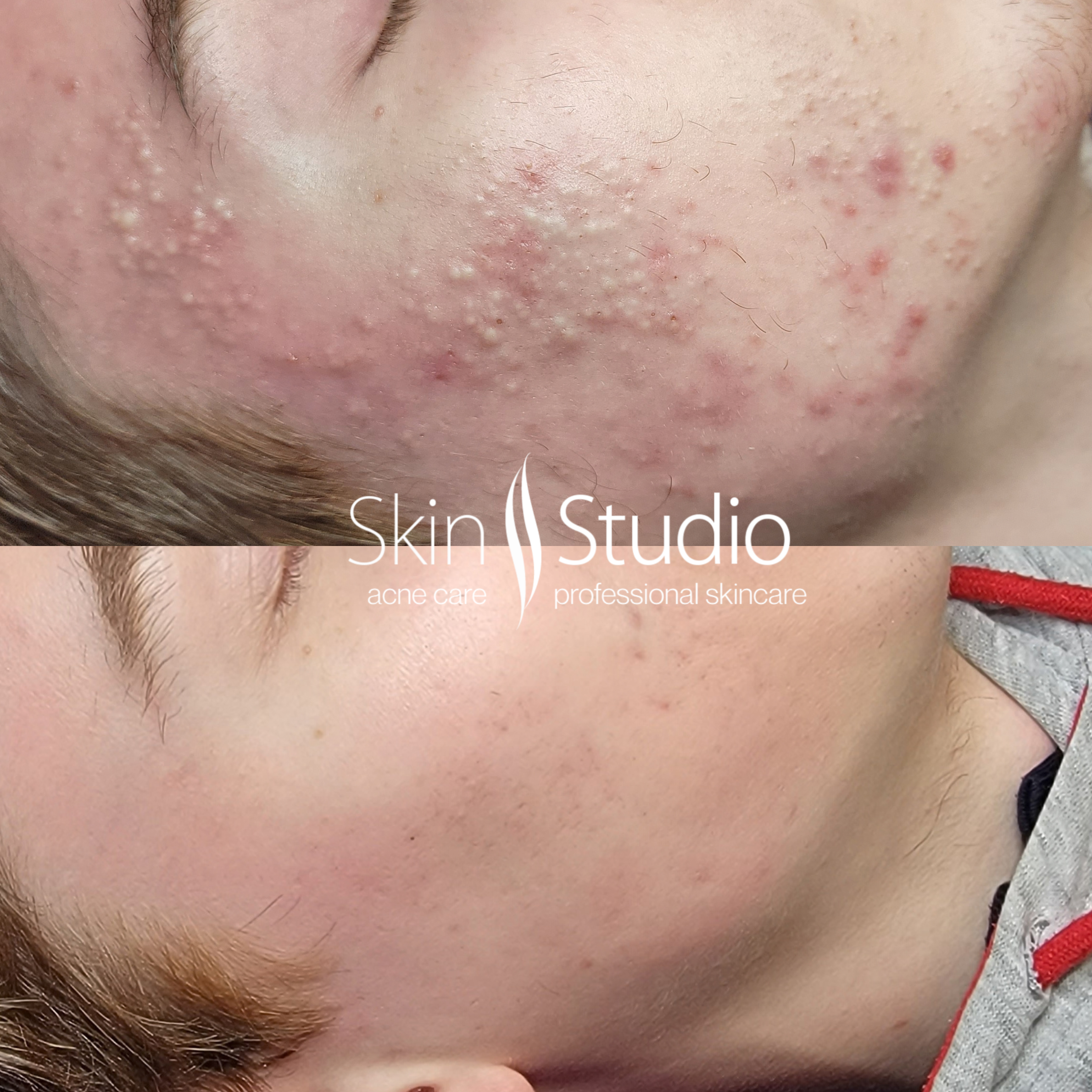 Clear Skin Is Possible: Our Acne Program in Natick, MA.