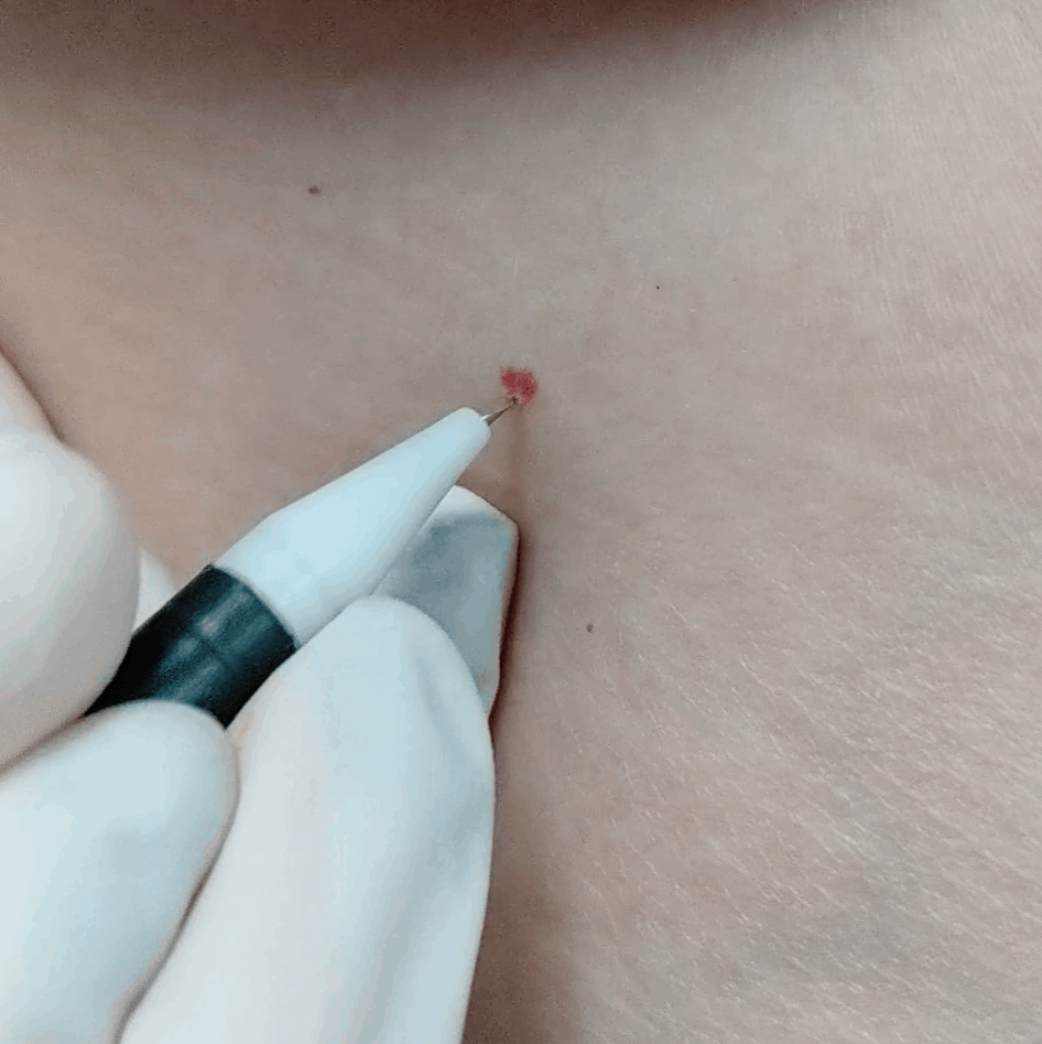 A close-up of a person's skin with a small red spot being punctured with a probe, wearing a white glove.
