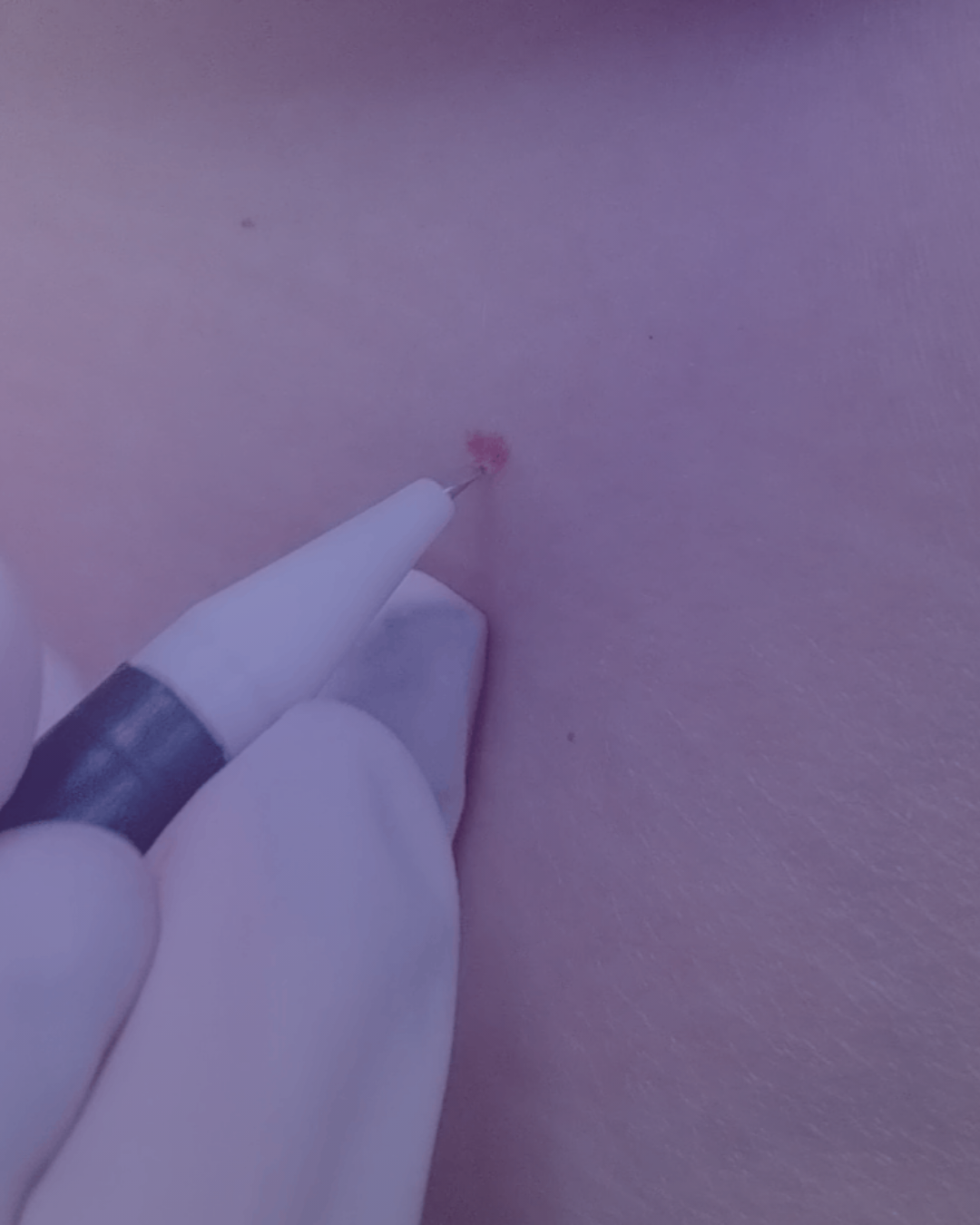 Close-up of a hand wearing a white medical glove using a small electric tool to perform a procedure on skin, possibly a mole removal or skin treatment.