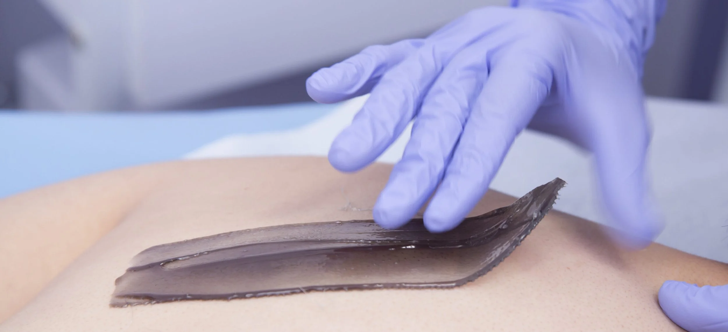 A person wearing blue gloves applying a sheet of charcoal therapy to a person's back.