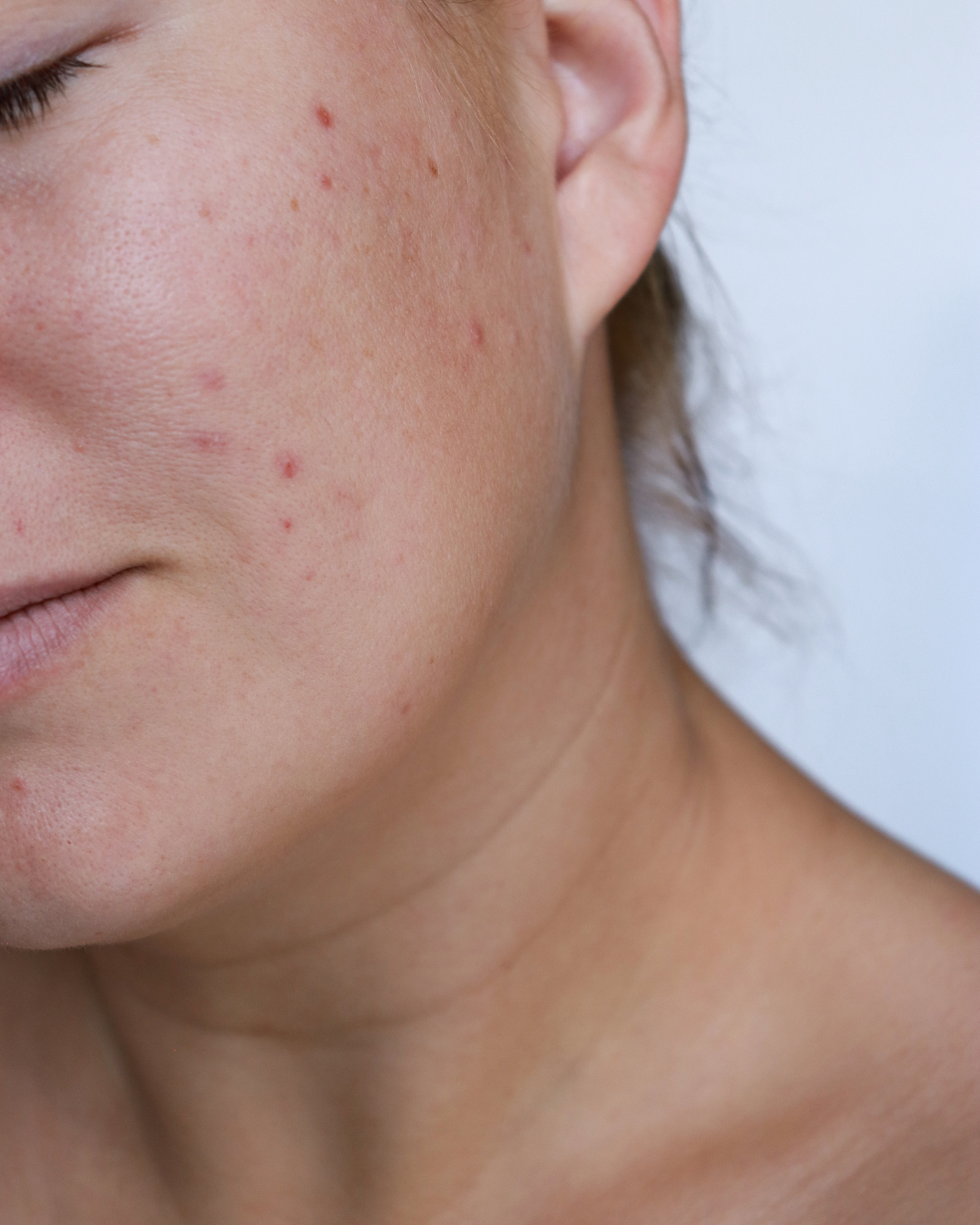 Close-up of a person's face showing acne and skin blemishes.