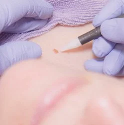 Close-up of a dermatological treatment, with a healthcare professional wearing gloves applying a small device to a patient's skin.