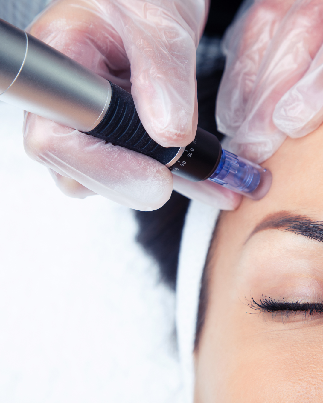 Close-up of a person receiving a cosmetic needle treatment near the eye with a gloved hand holding a device.