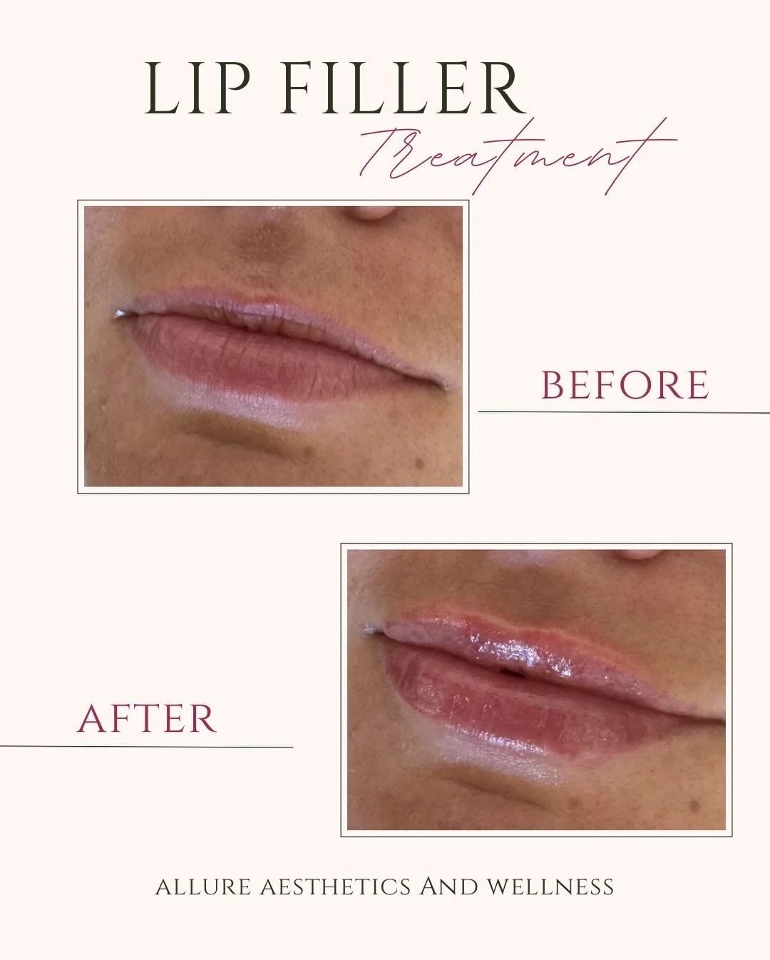 Classic Keyhole Pout💋

#lipfillers 
#aesthetic 
#rha
#aprn