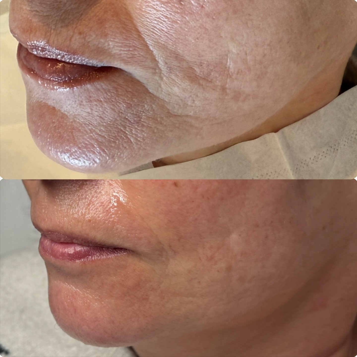 ✨ The 6-in-1 Hydra Facial &mdash; Your Ultimate Skin Upgrade ✨

Think of this as six professional electrical treatments in one powerhouse facial &mdash; designed to cleanse, tighten, hydrate and glow you from every angle.
Each step targets a differen