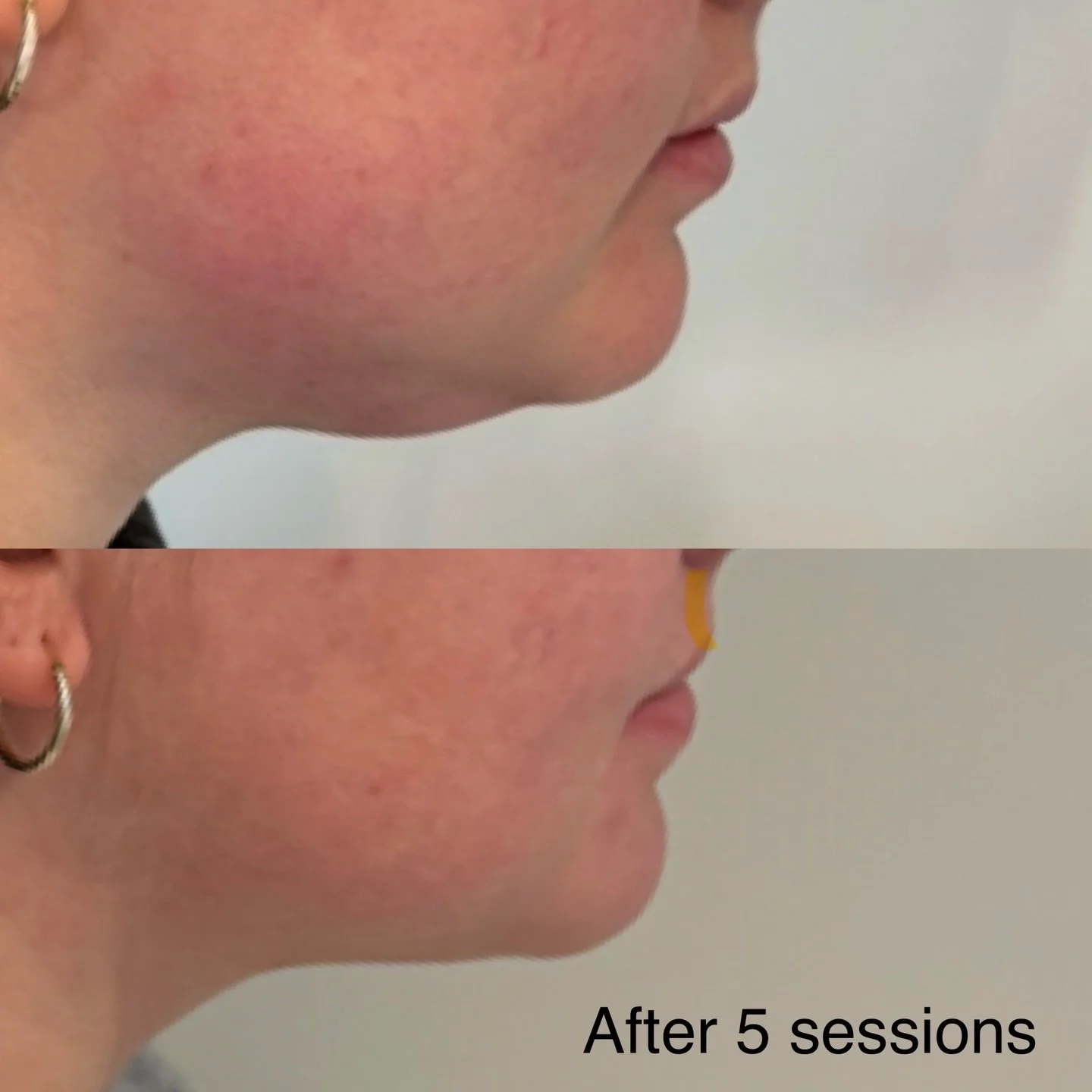 🍋 Lemon Bottle Fat Dissolve 🍋

This product blows me away each time ✨

Lemon bottle is a fat dissolving solution injected into subcutaneous fat tissue where it accelerates fat metabolism and breaks down fat cells, the body the naturally eliminates 