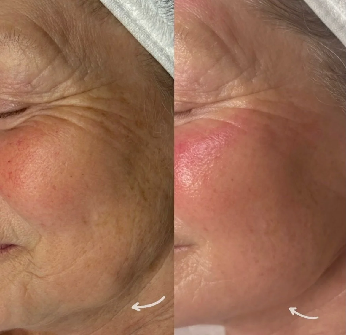 ✨THINK FACIALS ARE ENOUGH?&hellip; THINK AGAIN!✨

Microneedling is MORE than a facial it&rsquo;s a full cellular- level skin transformation. 
This advanced treatment created tiny micro channels in the skin, triggering your body&rsquo;s natural healin