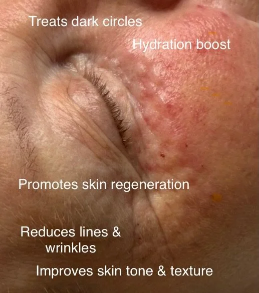 ✨Vitaran Eyes Polynucleotides- Targeted Eye Rejuvenation

The eye area is often the first place to show signs of ageing, fatigue and stress- and that&rsquo;s where Vitaran Eyes comes in 👁️✨

 🧬 What is Vitaran Eyes 
Vitaran Eyes is a polynucleotide