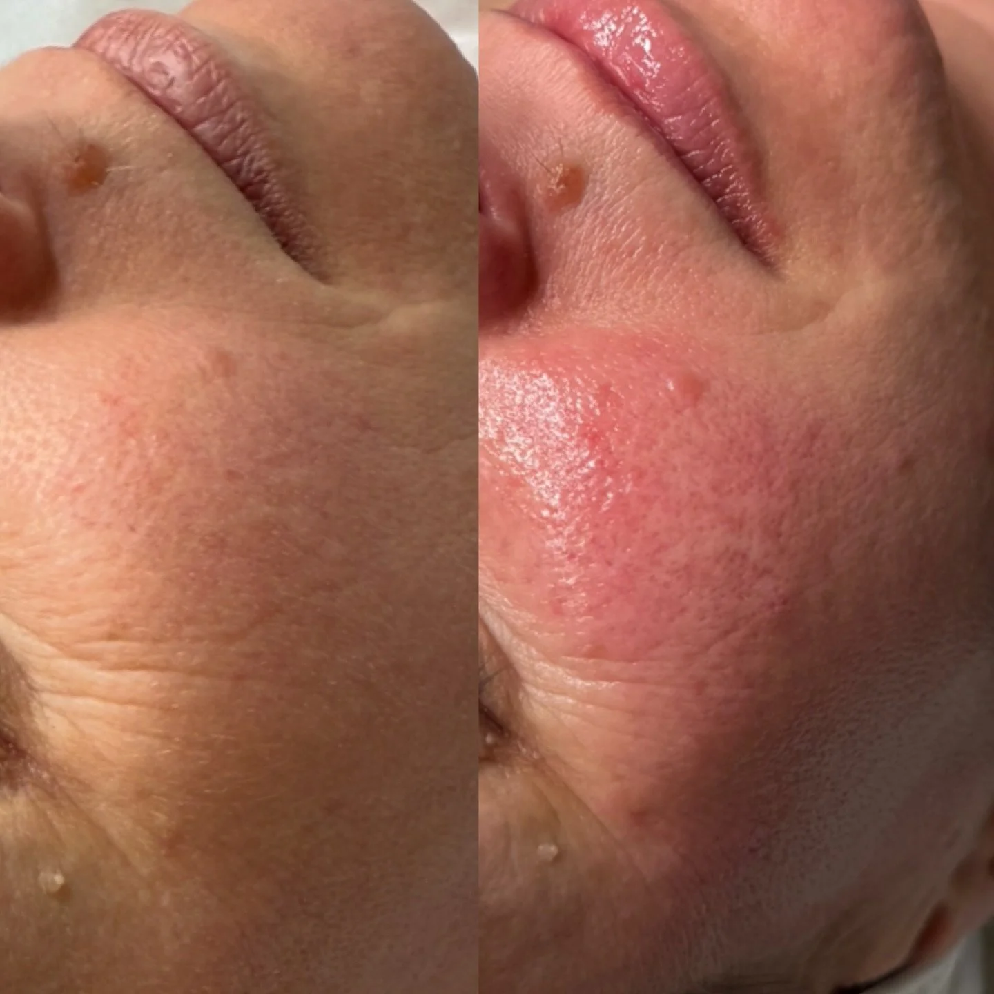 Because great skin isn&rsquo;t rushed&hellip;. It&rsquo;s rebuilt 💫

Microneedling works by creating tiny micro-channels in the skin, triggering your body&rsquo;s natural healing response and boosting collagen + elastin from within. 

⏰Here&rsquo;s 