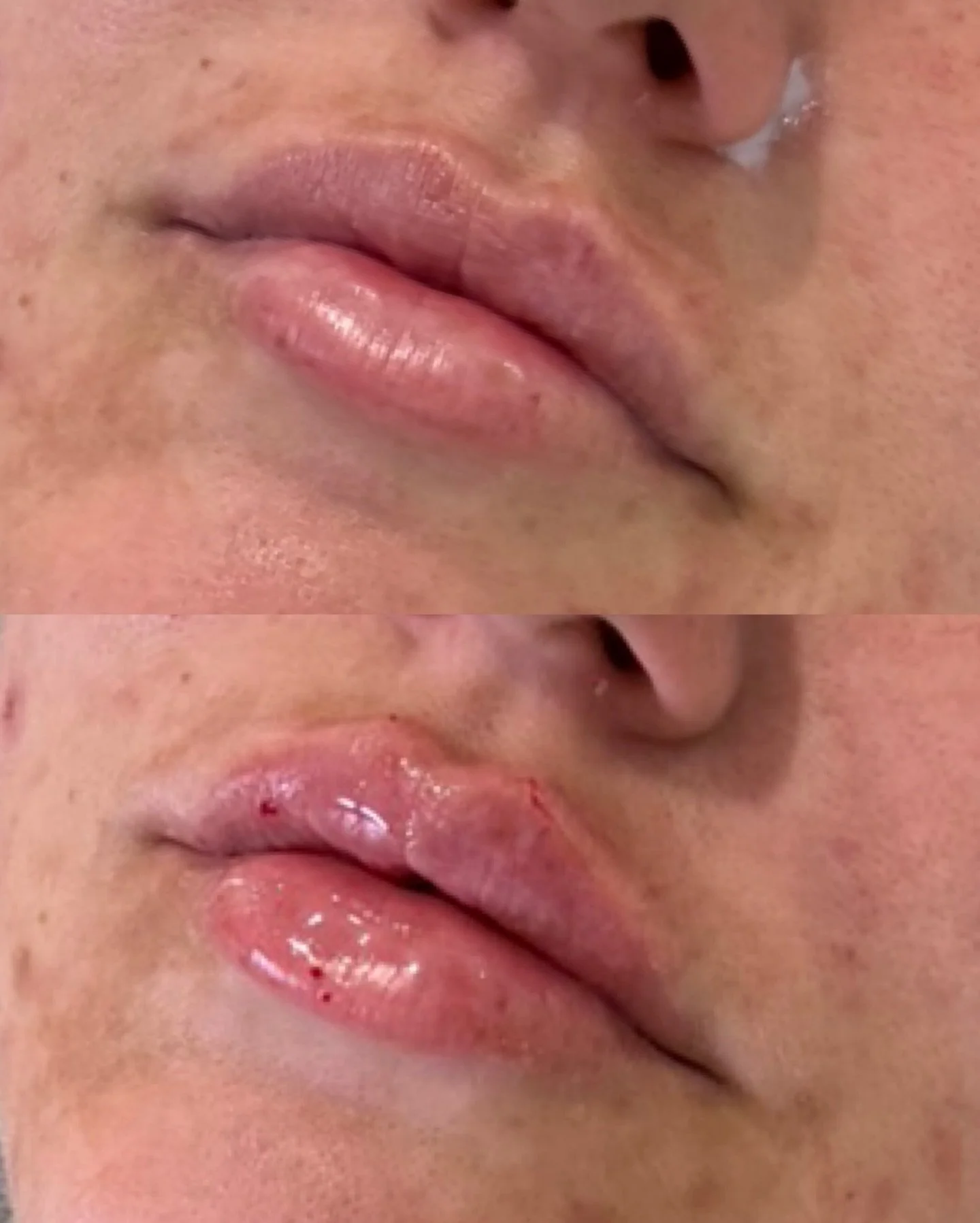 Beautiful Lips should look like they belong to you👄 

Every treatment I create is tailored to your features, your proportion and your goals because personalised results always win. 

These lips were enhanced with balance and volume was carefully pla