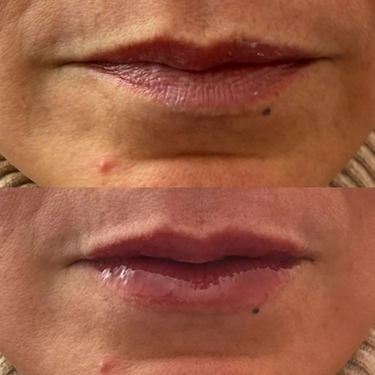 0.5ml Lip Filler adding volume and definition for natural looking lips 💋 

✔️Natural looking results
✔️Natural volume and definition 
✔️Hydrated smoother lips

@coco.rosebeauty my next clinic day here will be Wednesday 15th April. Thank you Rachael 