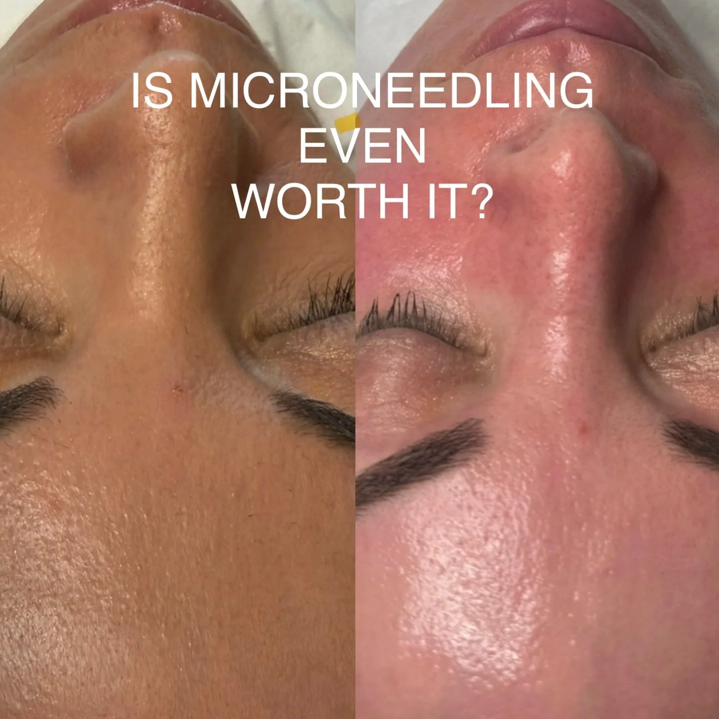 IS MICRONEEDLING EVEN WORTH IT?

Absolutely- and here&rsquo;s why&hellip;.

Microneedling is one of the most evidence-based, effective, results-driven skin treatments available in aesthetics today.
Unlike many treatments that only work on the surface