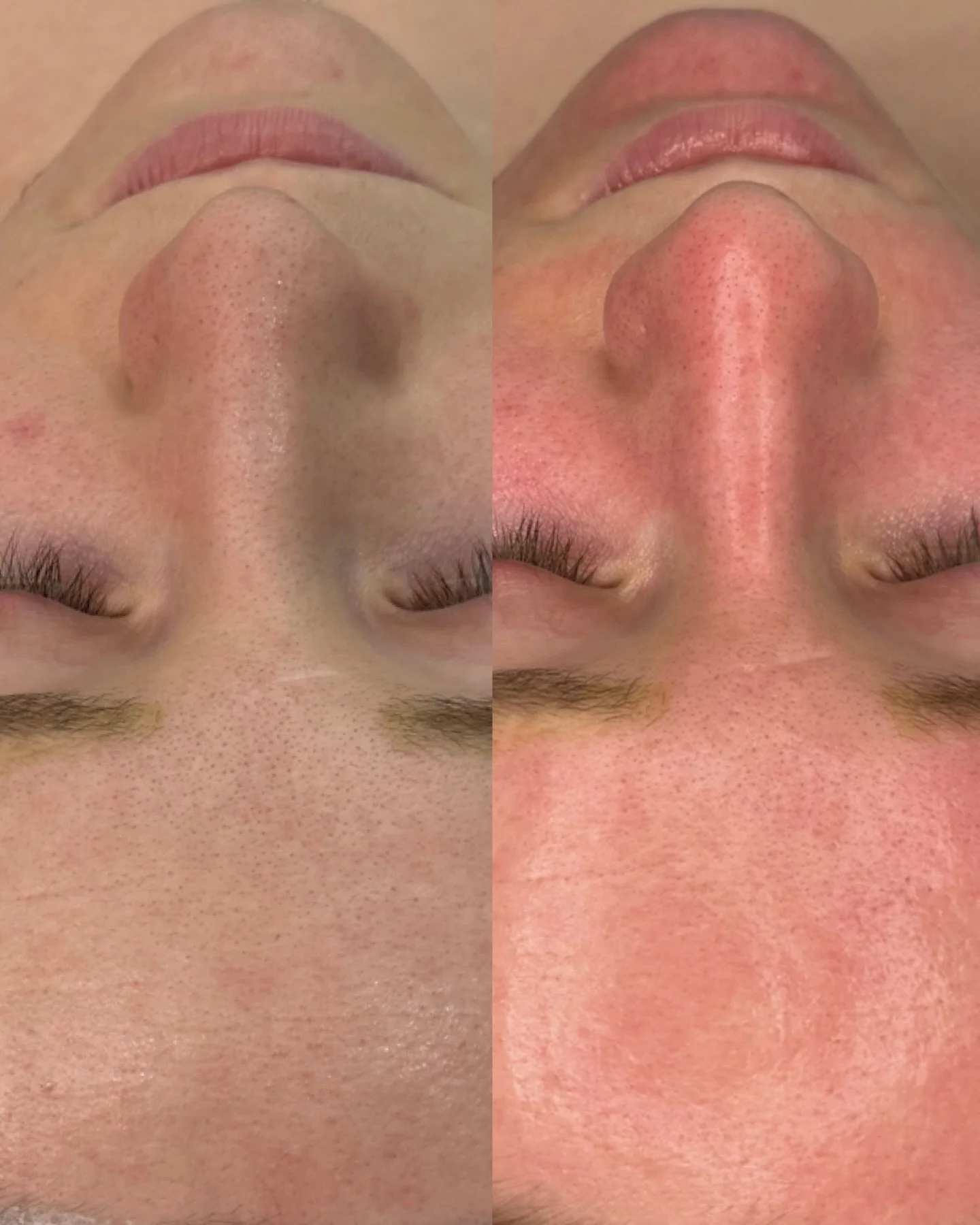 Let&rsquo;s talk about CHEMICAL PEELS&hellip;.

What&rsquo;s the first thing that comes into your head when you hear chemical peel?
Be honest.

Is it: 
&ldquo;Will I shed like a snake?&rdquo;
&ldquo;Will my face be bright red?&rdquo;
&ldquo;Is it too