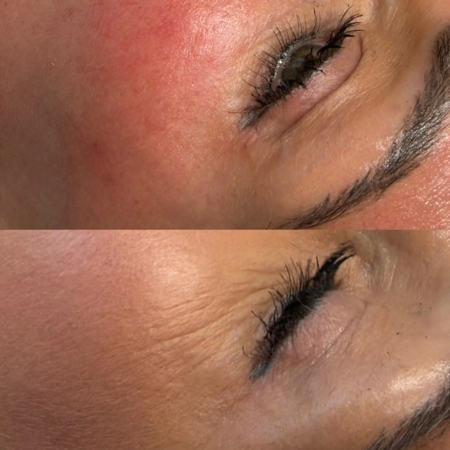 ✨The Ultimate Skin Reset, Why I combine treatments:
Dermaplaning, Chemical Peel &amp; Microneedling ✨

Great skin isn&rsquo;t about one treatment. It&rsquo;s about layering the right treatments in the right order for maximum results. 

Here&rsquo;s w