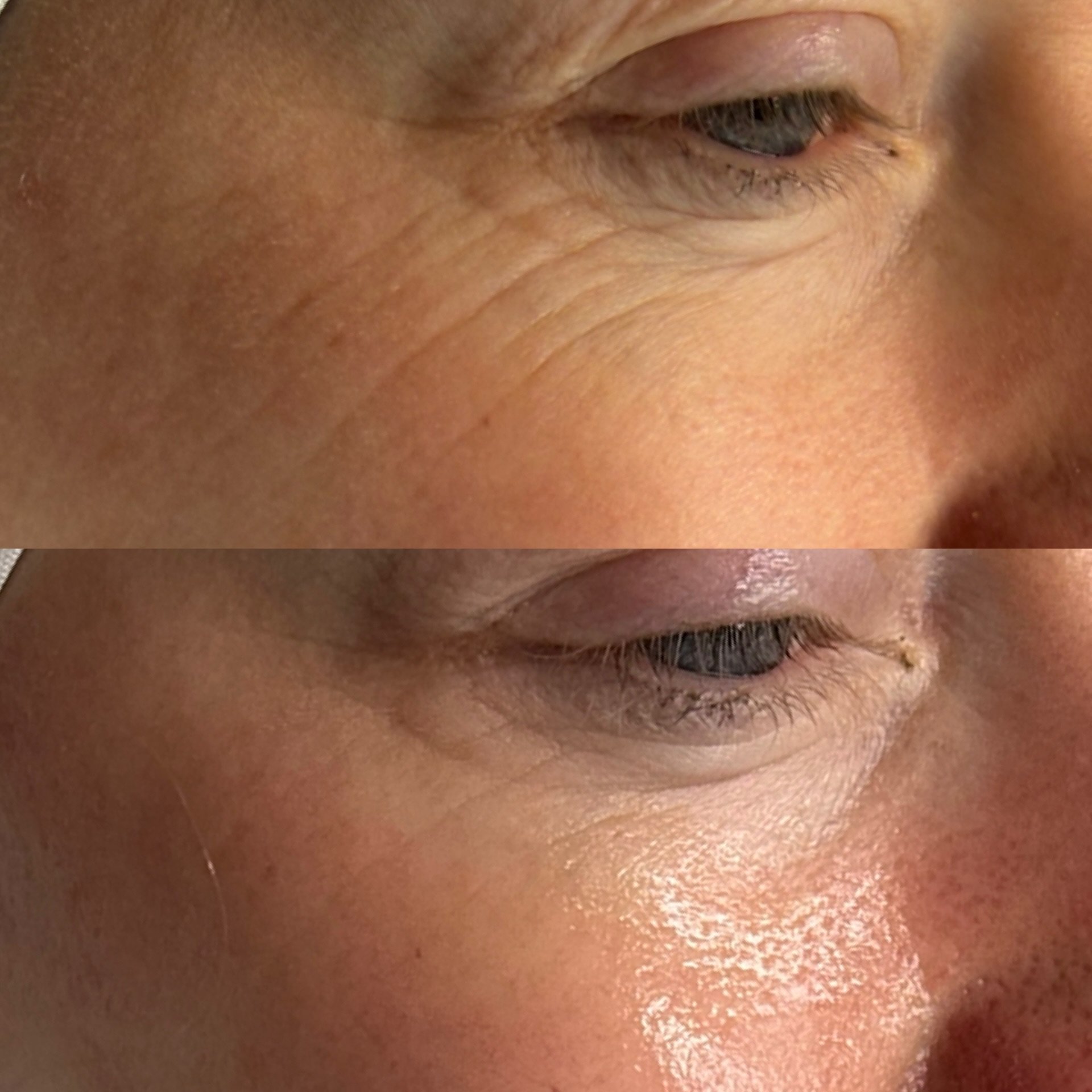 ✈️ Why get a Hydra Facial before your holiday 🏝️
 
Because glowing,hydrated skin makes everything better 💧

A Hydra Facial helps:
✨Deep cleanse &amp; exfoliate your skin
💦Boost hydration for that holiday glow 
🌸Smooth makeup application 
☀️Refres
