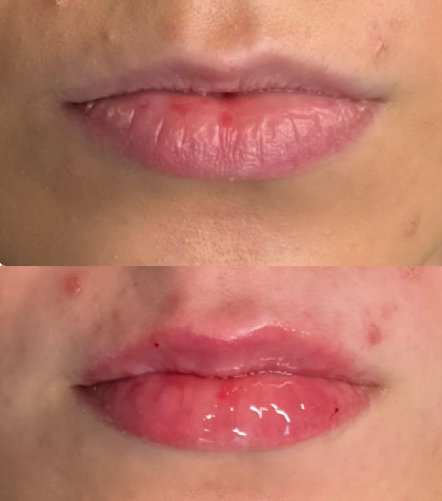 First lip appointment for my client 💋
We started with 0.5ml to keep things soft, natural and beautifully defined.

Lip filler isn&rsquo;t about adding volume for the sake of it- it&rsquo;s about creating balance and harmony with the whole face. 

Th