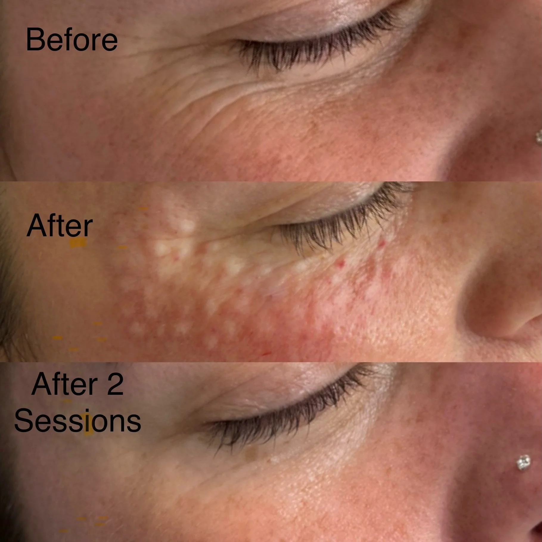 ✨The Treatment Everyone Is Talking About&hellip;.. Vitaran Polynucleotides ✨

These results are after 2 treatments of Vitaran ✨

Vitaran Polynucleotides work differently, rather than adding volume, this advanced regenerative treatment focuses on impr