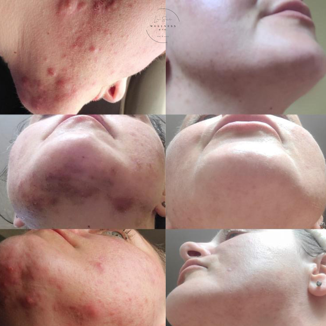 A collage of six close-up photos showing a person's skin before and after acne treatment, illustrating improvement in skin clarity and texture.