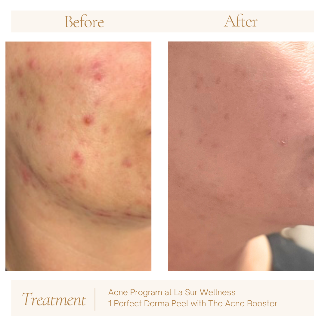 Before and after images showing improvement in acne; before has numerous red pimples, after has smoother skin with fewer pimples. Text indicates acne treatment at La Sur Wellness involving a derma peel and acne booster.