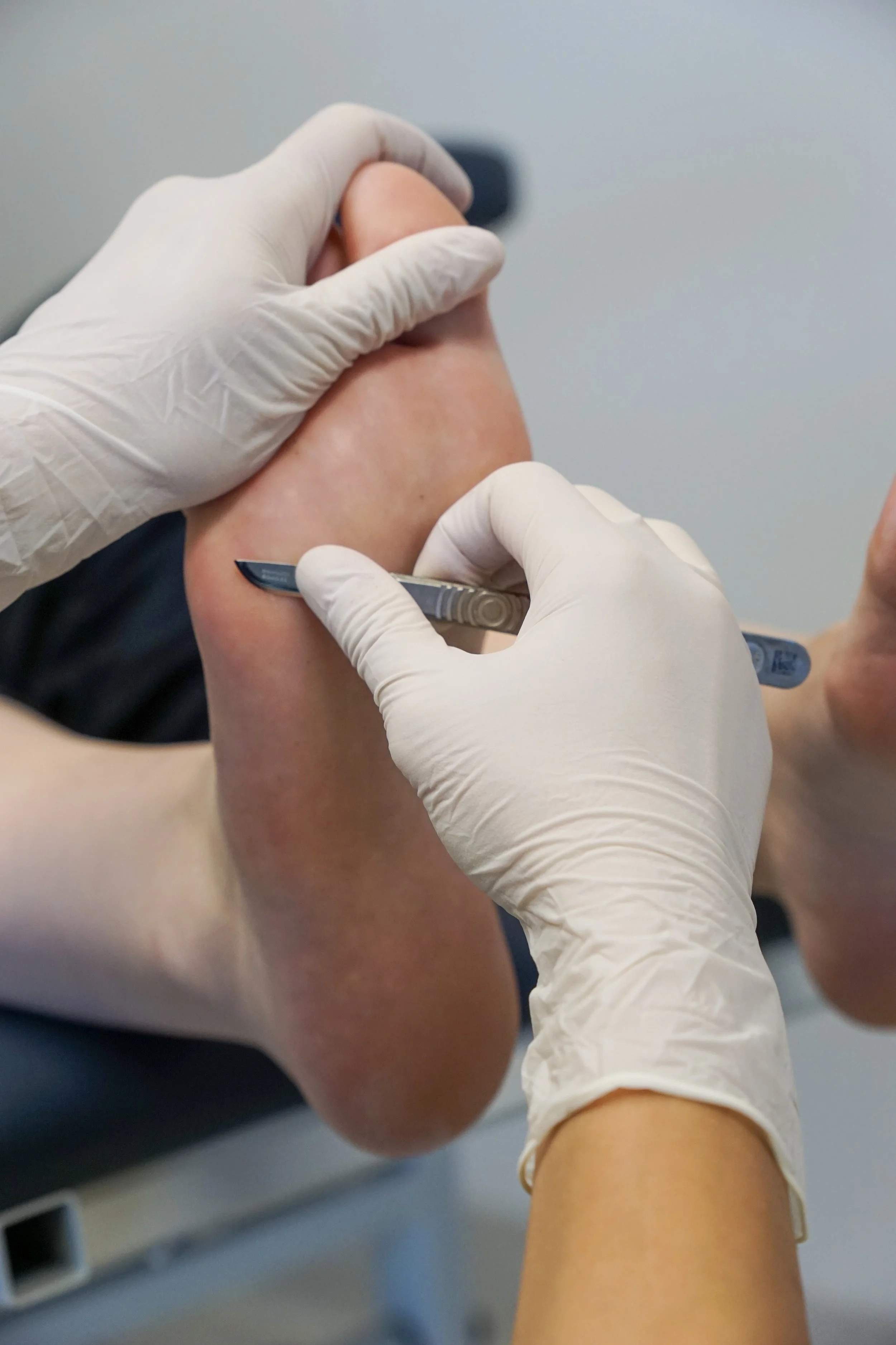 Plantar Warts Removal