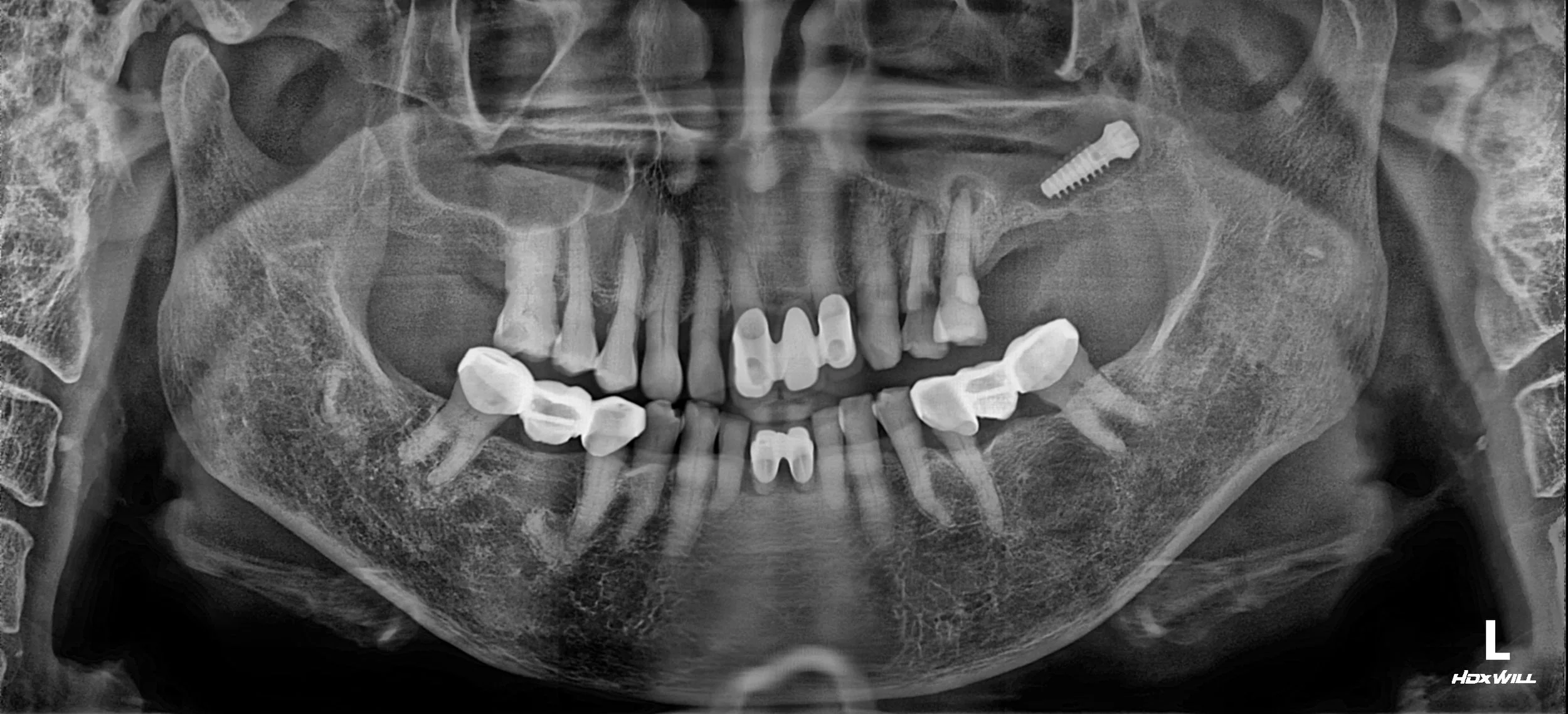 2. Maxillary Sinus Reconstruction &amp; Occlusal Rehabilitation