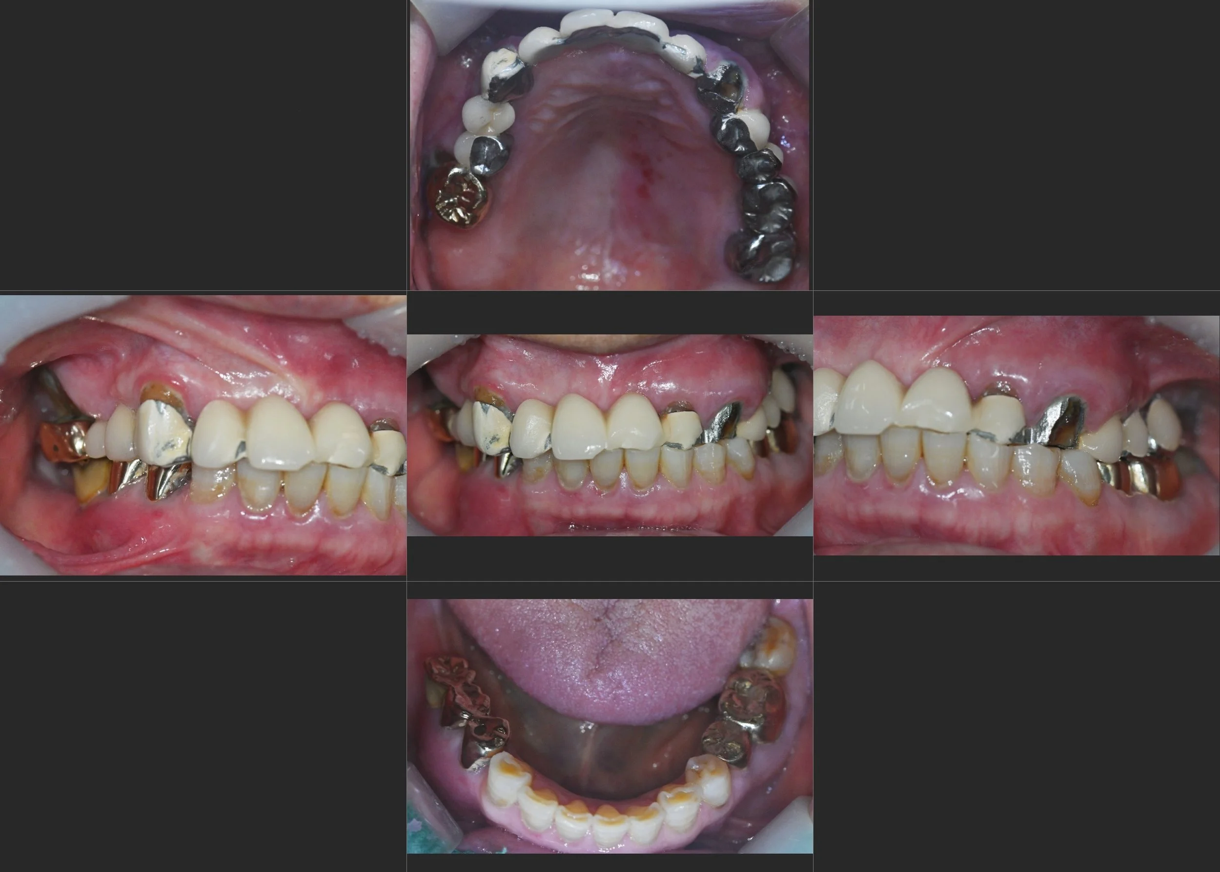 4. Occlusal Repositioning Following Failed Prosthetic Rehabilitation