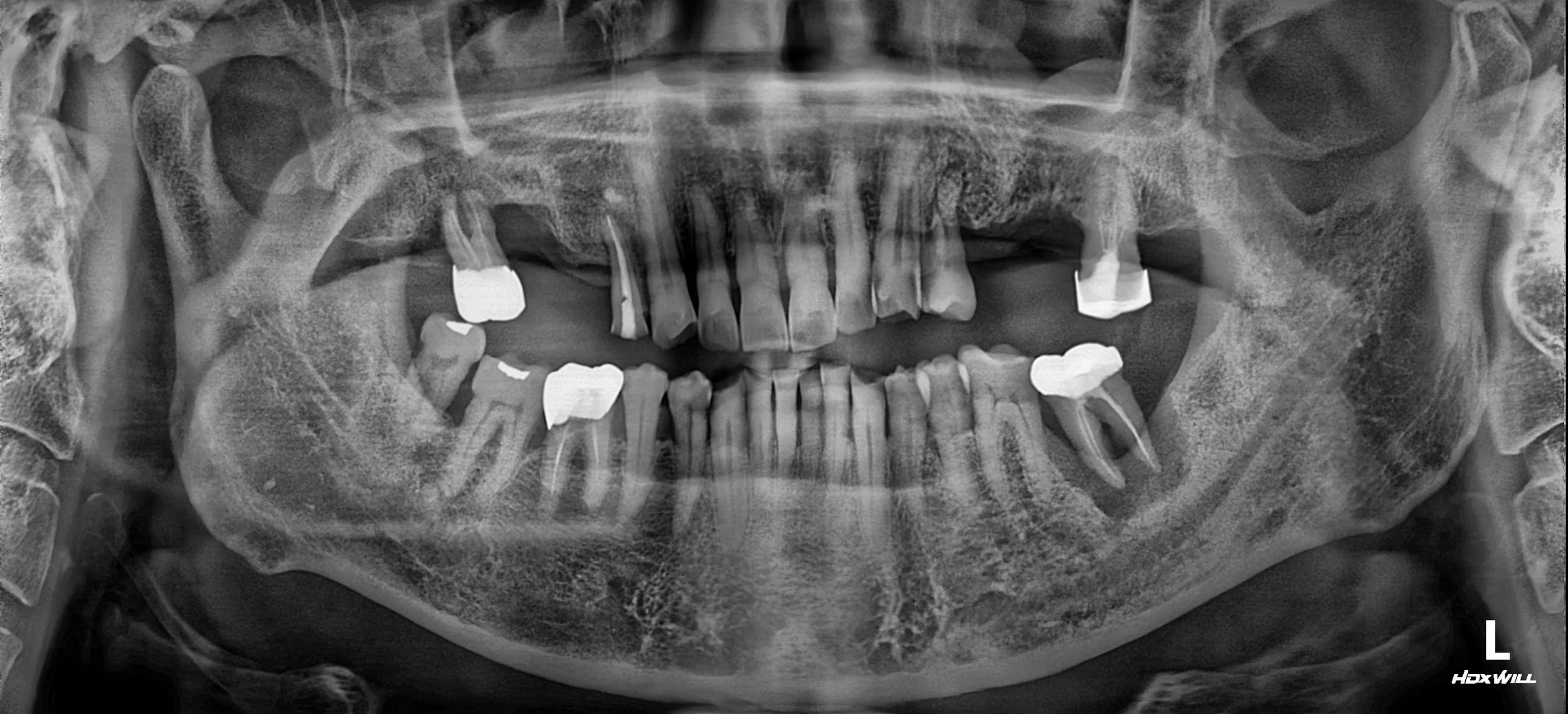 5. Occlusal Vertical Augmentation and Anterior Guidance Re-establishment
