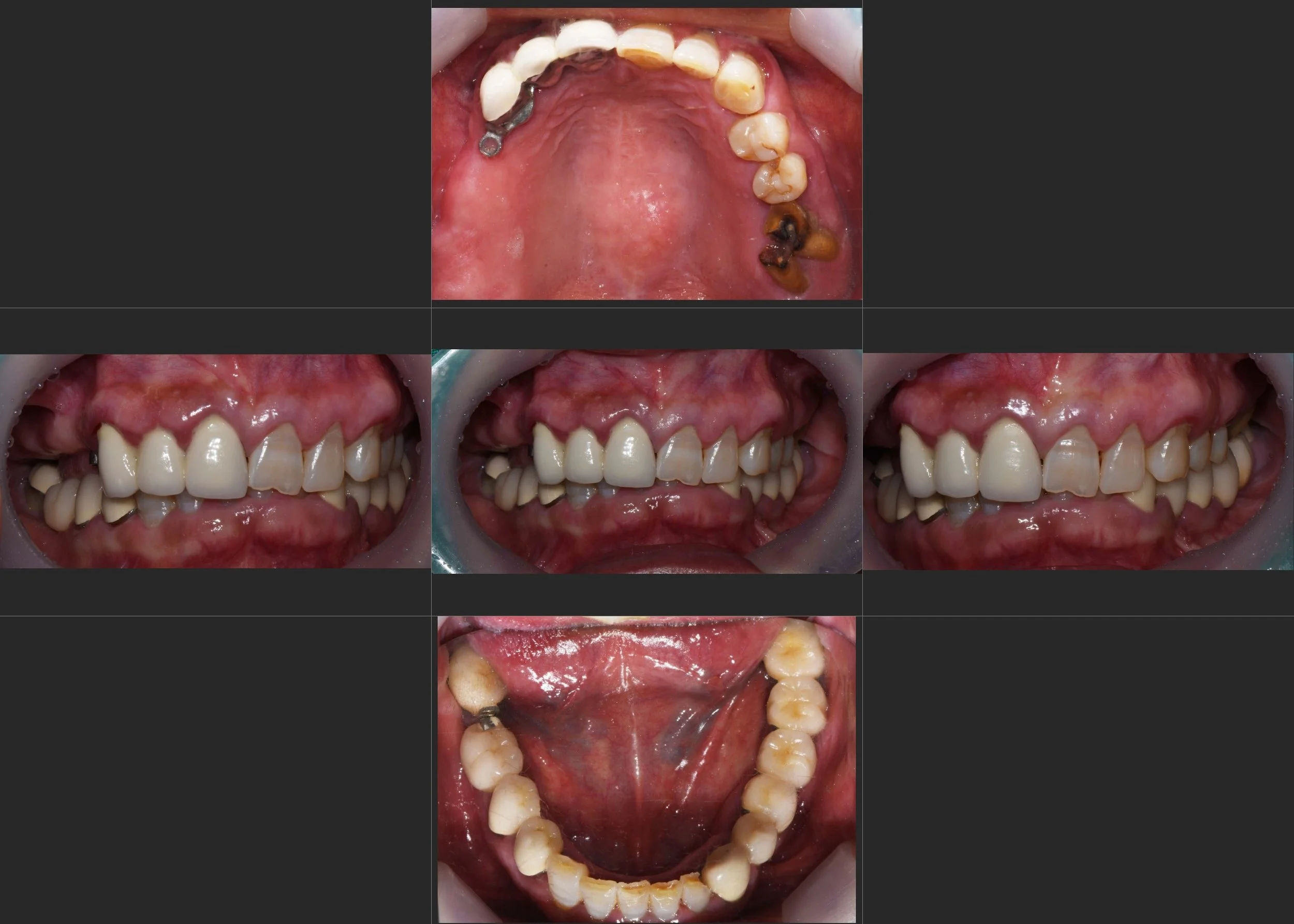 6. Occlusal Rehabilitation with Anterior Space Reconstruction