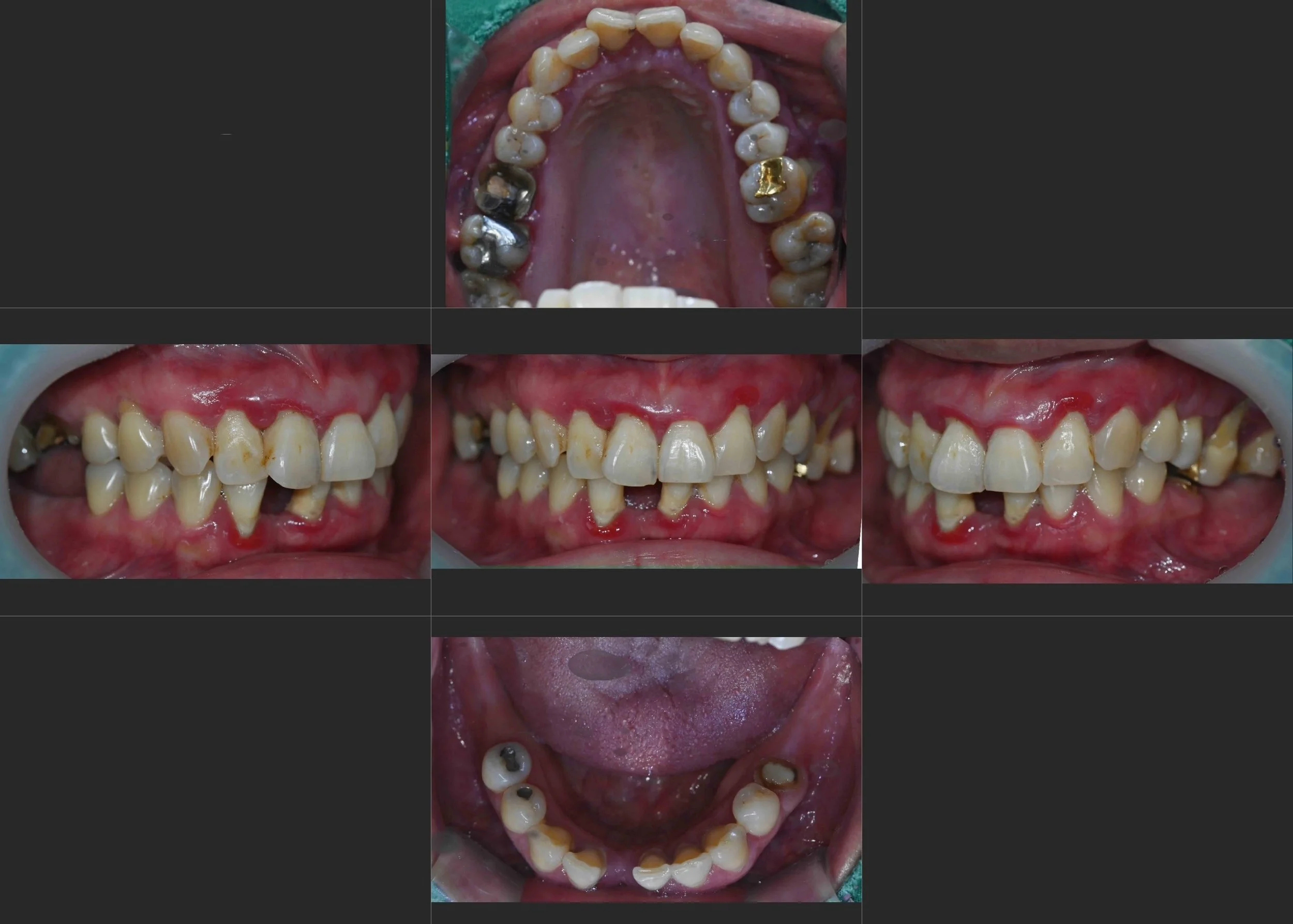 7. Occlusal Rehabilitation with Implant-Supported Posterior Reconstruction