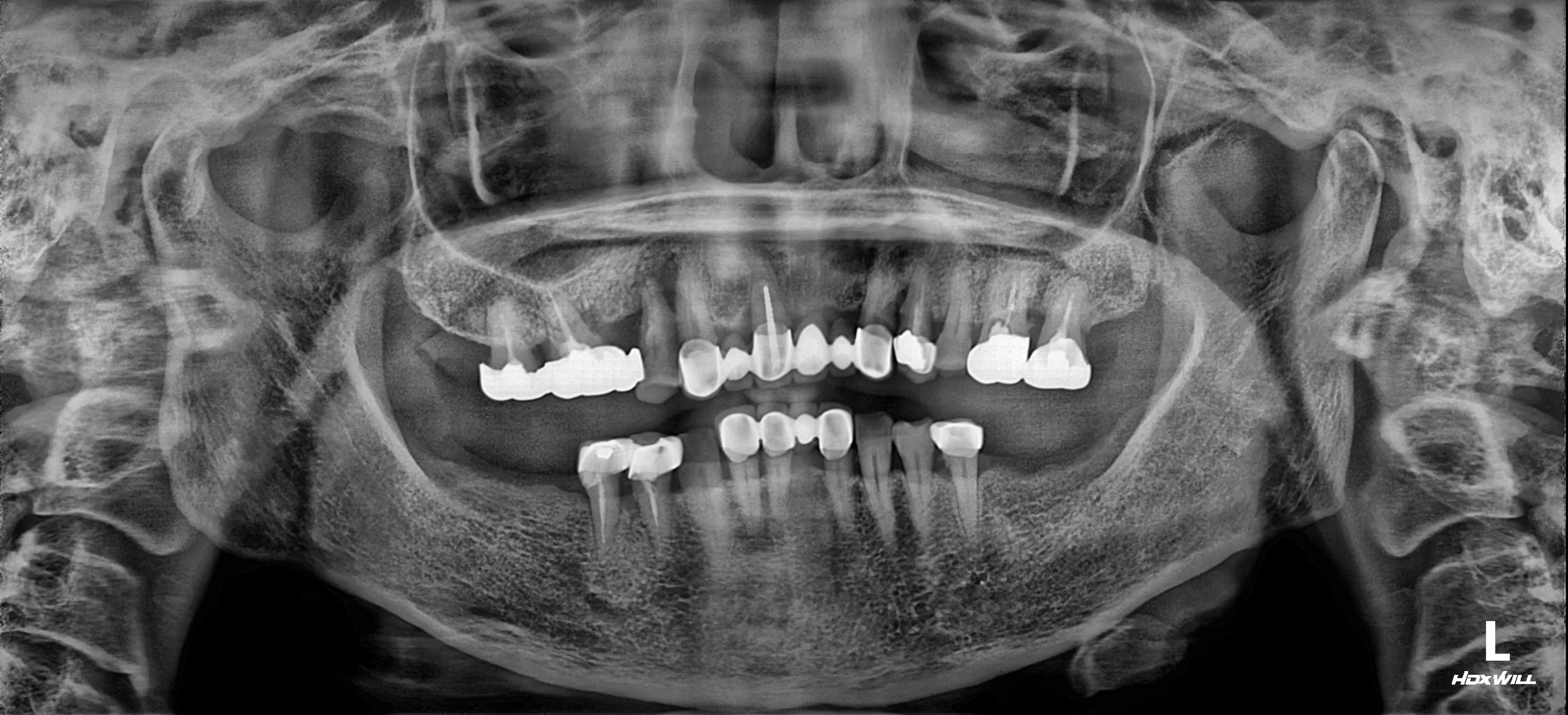 9. Occlusal Rehabilitation without Anterior Re-prosthesis