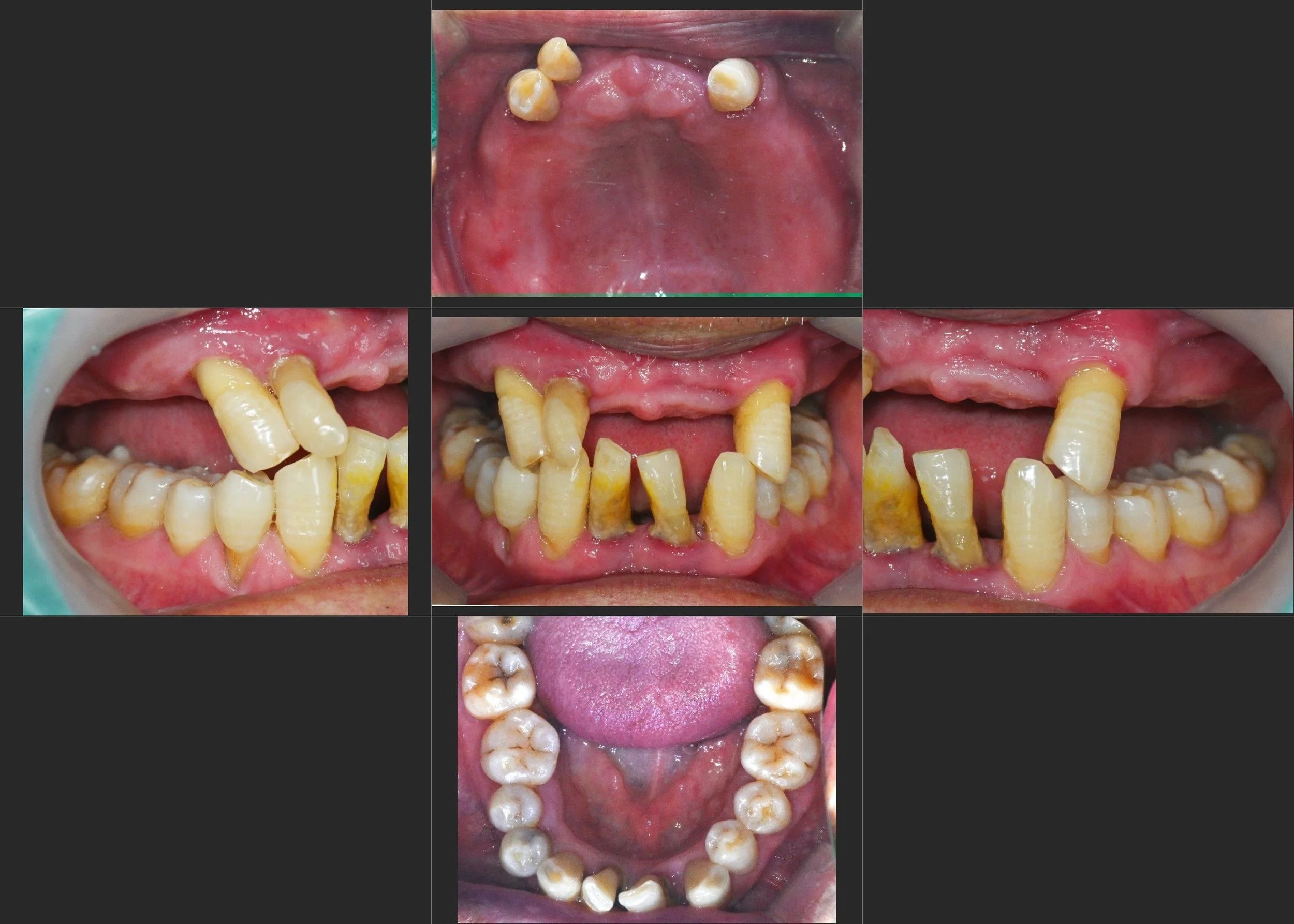 8. Implant-Supported Removable Partial Denture (ISRPD)
