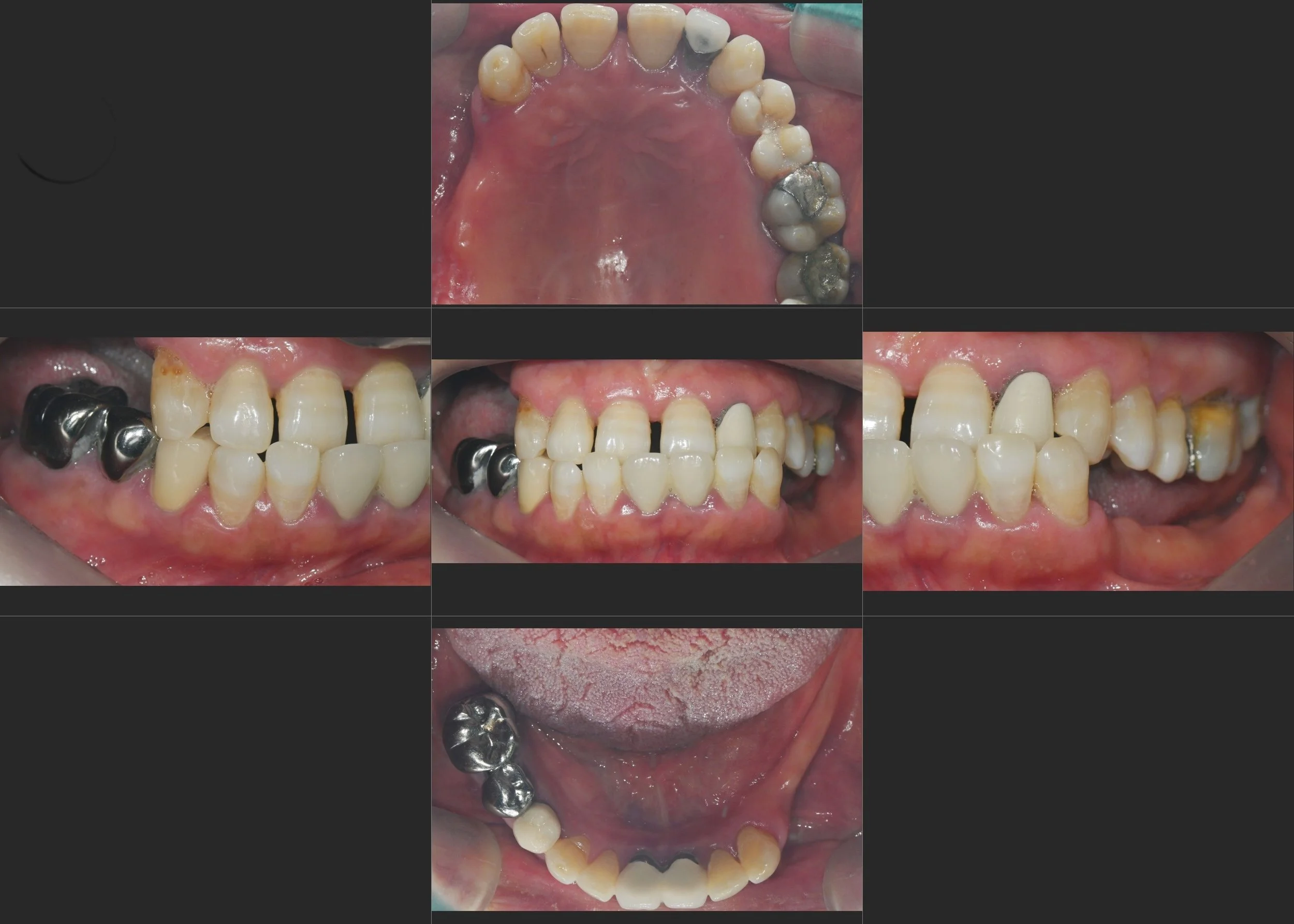 10. Anterior Crossbite with Functional Compromise in a Female Patient in Her 50s