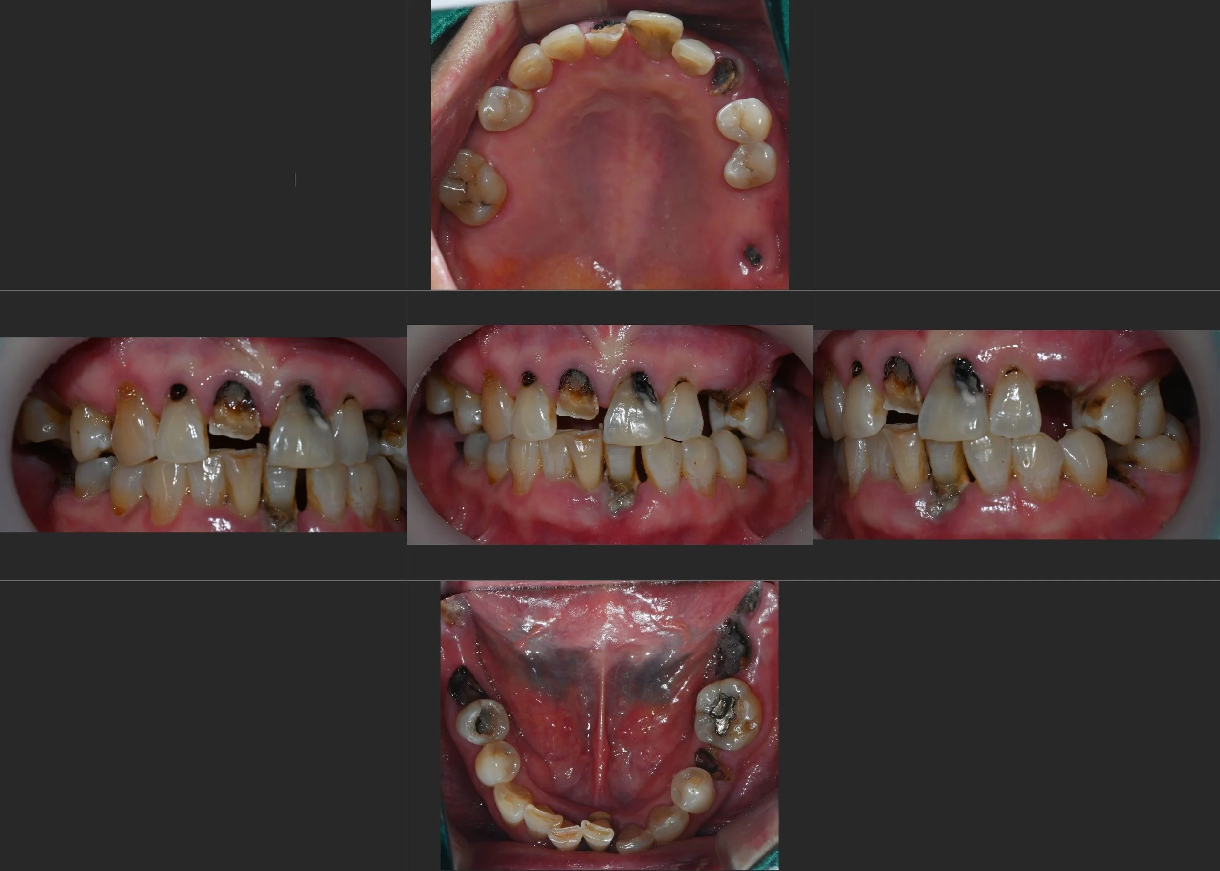 11. Full Mouth Rehabilitation Integrating Natural Teeth and Implants