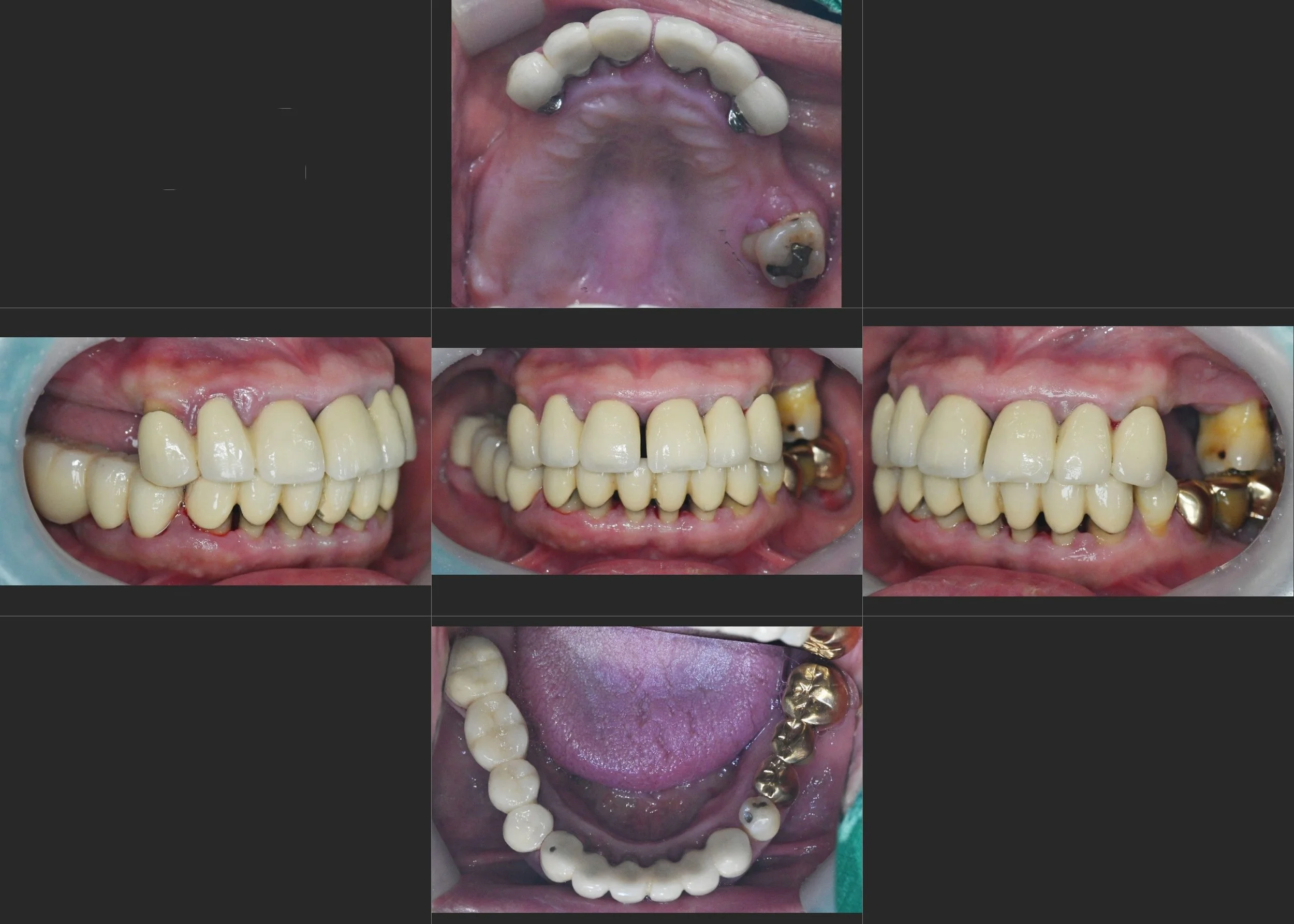 12. Comprehensive Full Mouth Rehabilitation: Restoring Vertical Dimension and Occlusal Stability
