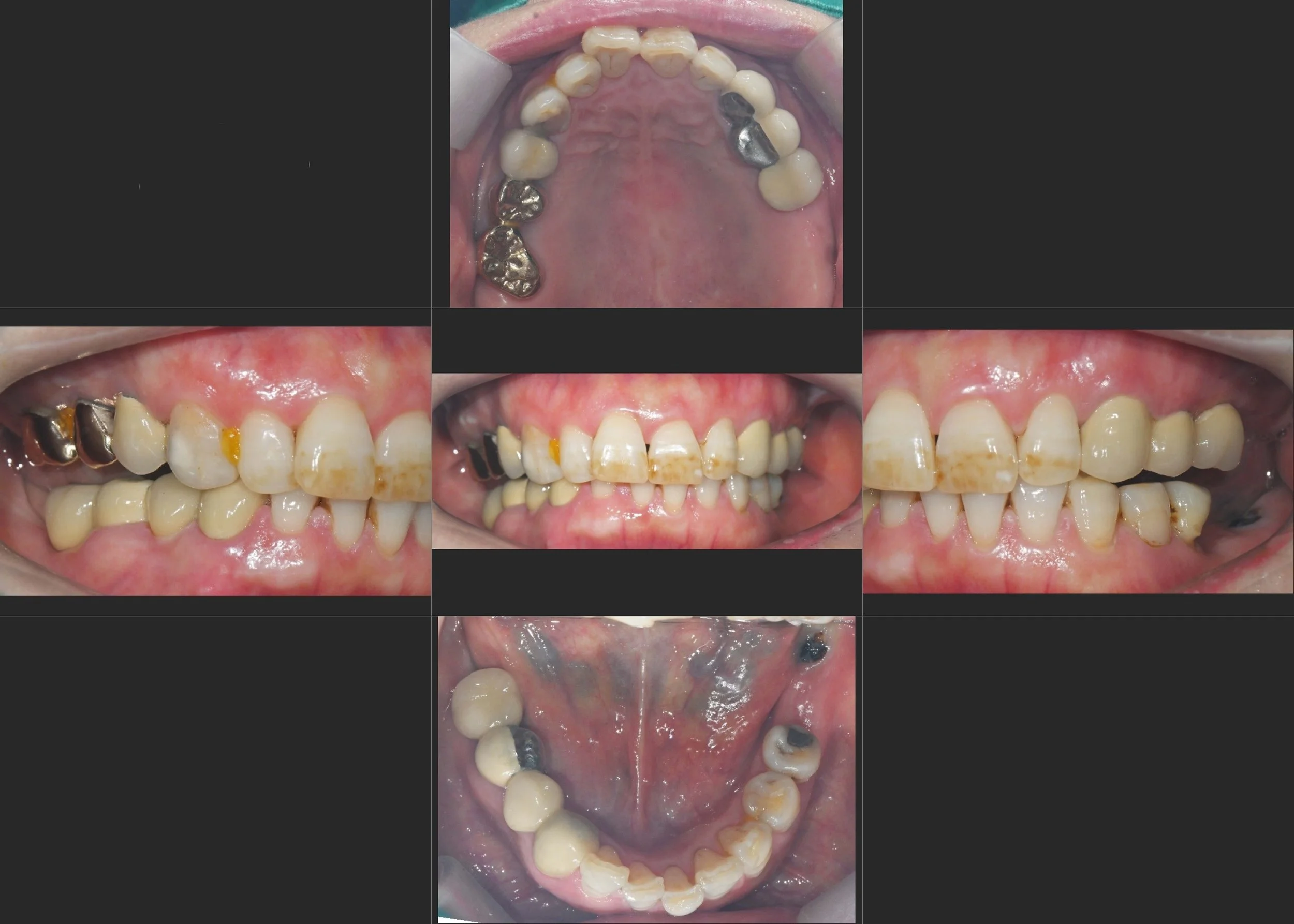 13. First VDO Elevation: Systematic Recovery of Occlusal Space and TMJ Function
