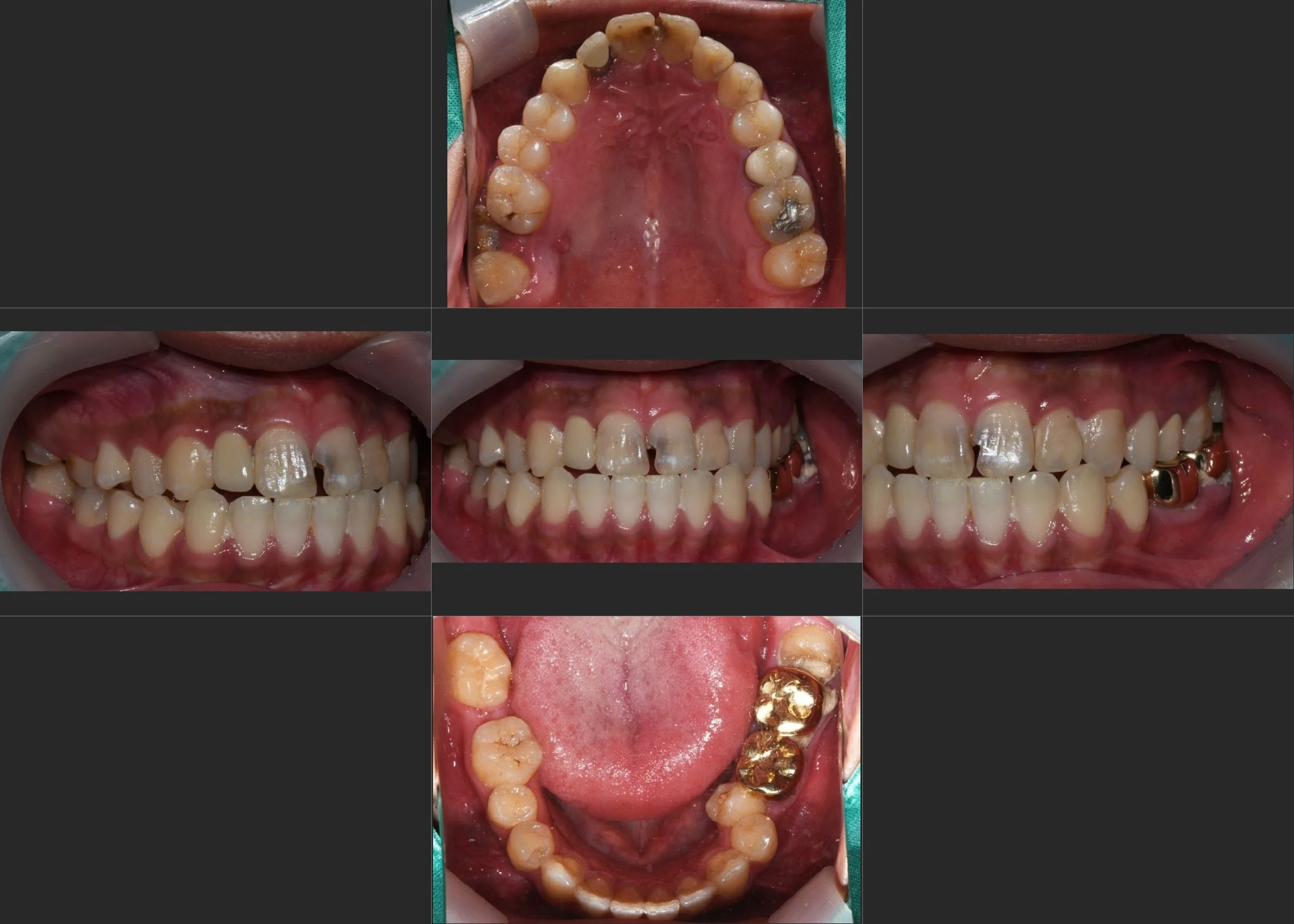 14. Comprehensive Aesthetic and Functional Realignment: Correcting Midline Discrepancy in a Young Adult